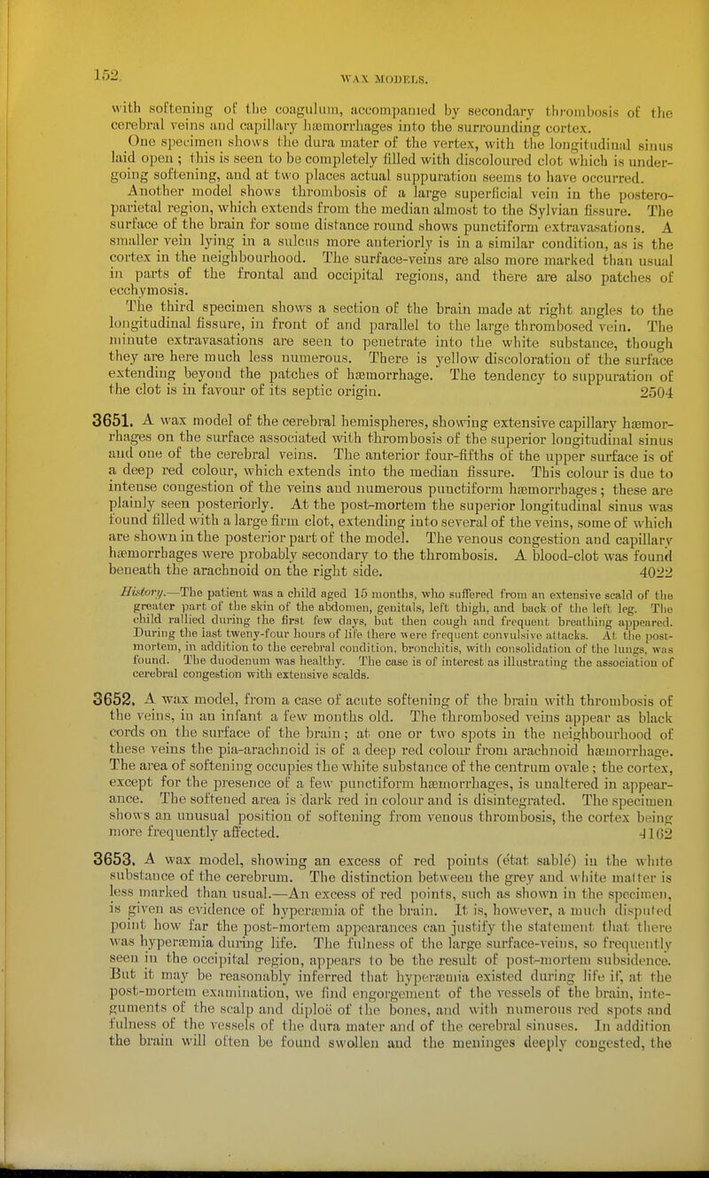 WA.X iM<)J)EI;S. with softening of the coaguluin, uccompanied by secondary thrombosis of the cerebral veins and capilhiry liaciiiorrhages into the surrounding cortex. One specimen shows the dura mater of the vertex, with the longitudinal sinus laid open ; this is seen to be completely filled with discoloured clot which is under- going softening, and at two places actual suppuration seems to have occurred. Another model shows thrombosis of a large superficial vein in the postero- pai'ietal region, which extends from the median almost to the Sylvian fissure. The surface of the brain for some distance round shows punctiforni extravasations. A smaller vein lying in a sulcus more anteriorly is in a similar condition, as is the cortex in the neighbourhood. The surface-veins are also more marked than usual in parts of the frontal and occipital regions, and there are also patches of ecchymosis. The third specimen shows a section of the brain made at right angles to the longitudinal fissure, in front of and parallel to the large thrombosed vein. The minute extravasations are seen to penetrate into the white substance, though they are here much less numerous. There is yellow discoloration of the surface extending beyond the patches of hsemorrhage. The tendency to suppuration of the clot is in favour of its septic origin. 2504 3651. A wax model of the cerebral hemispheres, showing extensive capillary haemor- rhages on the surface associated with thrombosis of the superior longitudinal sinus and one of the cerebral veins. The anterior four-fifths of the upper surface is of a deep red colour, which extends into the median fissure. This colour is due to intense congestion of the veins and numerous punctiform hajmorrbages; these are plainly seen posteriorly. At the post-mortem the superior longitudinal sinus was found filled with a large firm clot, extending into several of the veins, some of which are shown in the posterior part of the model. The venous congestion and capillarv haemorrhages were probably secondary to the thrombosis. A blood-clot was found beneath the arachnoid on the right side. 4022 Bistort/.—The patient was a clnld aged 15 months, who suffered from an extensive scald of the greater part of the skin of the abdomen, genitals, left thigh, and back of the left leg. The L-hild rallied during the first few days, but then cough and fi-oqiient breathing appeared. During the last tweny-four hours of life there were frequent convulsive aUacks. At the post- mortem, in addition to the cerebral condition, bronchitis, with consolidation of the lungs, was found. The duodenum was liealthy. The case is of interest as illustrating the association of cerebral congestion with extensive scalds. 3652. A wax model, from a case of acute softening of the brain with thrombosis of the veins, iu an infant a few months old. The thrombosed veins appear as black cords on the surface of the brain; at one or two spots in the neighbourhood of these veins the pia-arachnoid is of a deep red colour from arachnoid haeuiorrhage. The area of softening occupies the white substance of the centrum ovale; the cortex, except for the presence of a few punctiform haemorrhages, is unaltered in appear- ance. The softened area is dark red in colour and is disintegrated. The specimen shows an unusual position of softening from venous thrombosis, the cortex being more frequently affected. -J 162 3653. A wax model, showing an excess of red points (etat sable) iu the white substance of the cerebrum. The distinction between the grey and wliite matter is less marked than usual.—An excess of red points, such as shown in the specimen, IS given as evidence of hypcrtpmia of the brain. It is, however, a mui-h disputed point how far the post-mortem appearances can justify the statement tliat there was hypertemia during life. The fulness of the large stu'face-veins, so frequently seen in the occipital region, appears to be the result of post-mortem subsidence. But it may be reasonably inferred that hyperajmia existed during life if, at the post-mortem examination, we find engorgement of the vessels of the brain, inte- guments of the scalp and diploid of the bones, and with numerous red spots and fulness of the vessels of the dura mater and of the cerebral sinuses. In addition the brain will often be found swollen and the meninges deeply congested, the