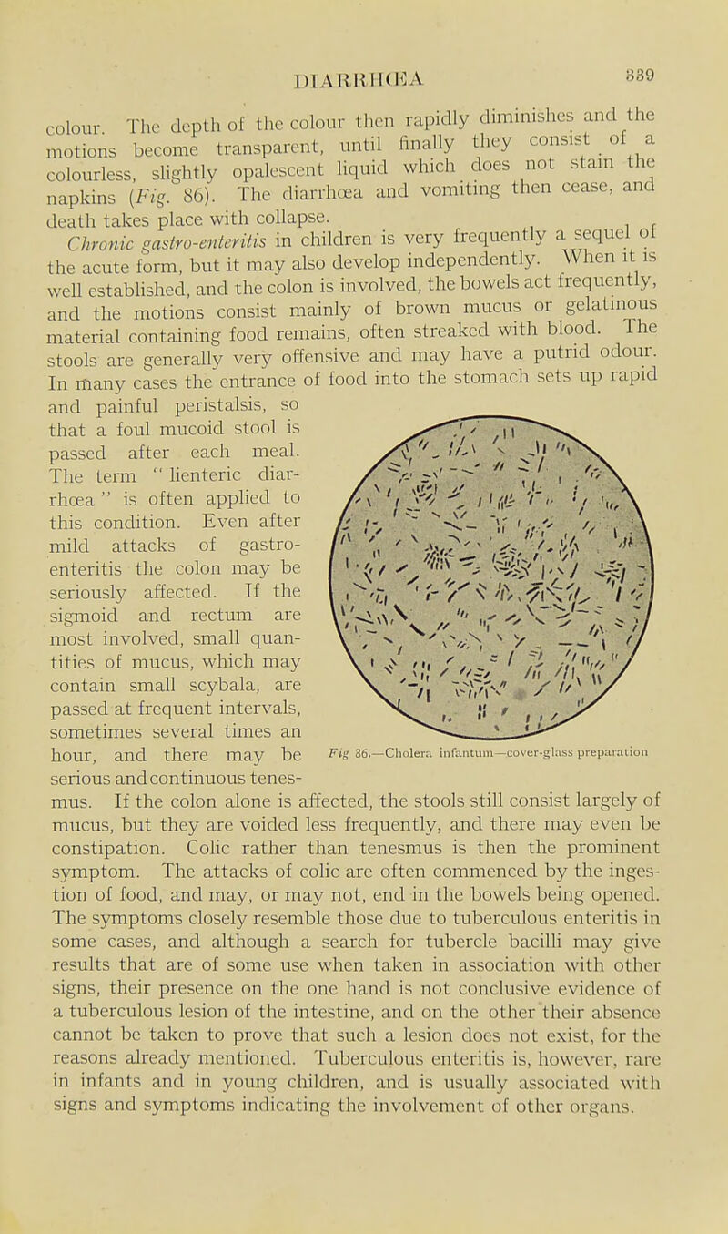 I)1ARHH(EA colour The depth of the colour then rapidly dminiishcs and the motions become transparent, until finally they consist of a colourless, sHghtly opalescent liquid which does not stam the napkins {Fig. 86). The diarrhcea and vomitmg then cease, and death takes place with collapse. Chronic qasiro-enteritis in children is very frequently a sequel of the acute form, but it may also develop independently. When it is well established, and the colon is involved, the bowels act frequently, and the motions consist mainly of brown mucus or gelatinous material containing food remains, often streaked with blood. The stools are generally very offensive and may have a putrid odour. In many cases the entrance of food into the stomach sets up rapid and painful peristalsis, so that a foul mucoid stool is passed after each meal. The terni  lienteric diar- rhoea  is often apphed to this condition. Even after mild attacks of gastro- enteritis the colon may be seriously affected. If the sigmoid and rectum are most involved, small quan- tities of mvicus, which may contain small scybala, are passed at frequent intervals, sometimes several times an hour, and there may be serious and continuous tenes- mus. If the colon alone is affected, the stools still consist largely of mucus, but they are voided less frequently, and there may even be constipation. Colic rather than tenesmus is then the prominent symptom. The attacks of colic are often commenced by the inges- tion of food, and may, or may not, end in the bowels being opened. The symptoms closely resemble those due to tuberculous enteritis in some cases, and although a search for tubercle bacilli may give results that are of some use when taken in association with other signs, their presence on the one hand is not conclusive evidence of a tuberculous lesion of the intestine, and on the other their absence cannot be taken to prove that such a lesion does not exist, for the reasons already mentioned. Tuberculous enteritis is, however, rare in infants and in young children, and is usually associated with signs and symptoms indicating the involvement of other organs. Fig 36.—Cholera infantum—cover-glass prepaialion