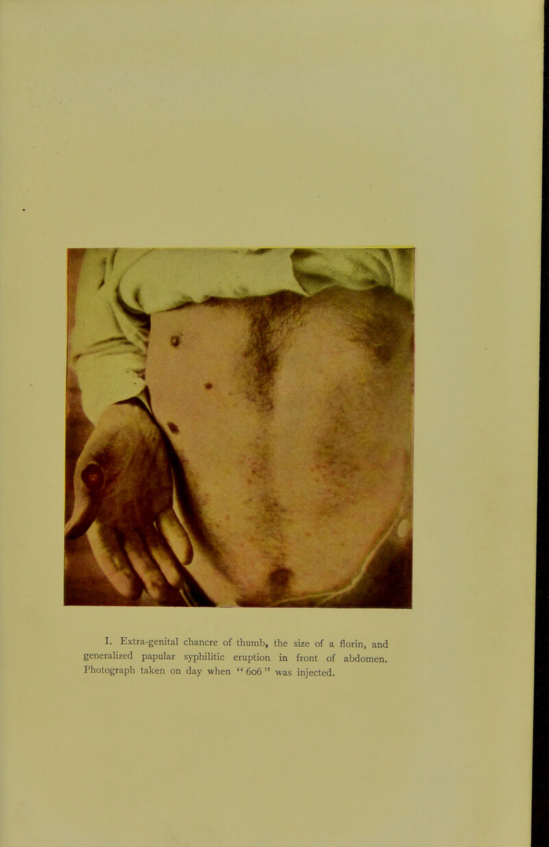 I. Extra-genital chancre of thumb, the size of a florin, and generalized papular syphilitic eruption in front of abdomen. Photograph taken on day when  606  was injected.