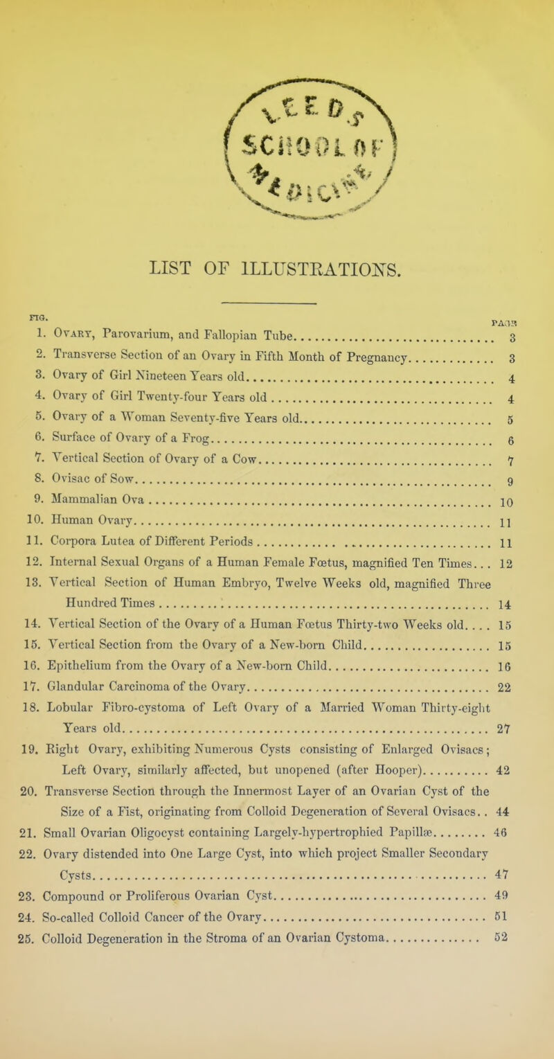 LIST OF ILLUSTEATIOis'S. 1. Ovary, Parovarium, and Fallopian Tube 3 2. Transverse Section of an Ovary in Fifth Month of Pregnancy 3 3. Ovary of Girl Nineteen Years old 4 4. Ovary of Girl Twenty-four Years old 4 5. Ovary of a Woman Seventy-five Years old 5 6. Surface of Ovary of a Frog 6 7. Vertical Section of Ovary of a Cow 7 8. Ovisac of Sow 9 9. Mammalian Ova 1q 10. Human Ovary U 11. Corpora Lutea of Different Periods 11 12. Internal Sexual Organs of a Human Female Foetus, magnified Ten Times... 12 13. Vertical Section of Human Embryo, Twelve Weeks old, magnified Three Hundred Times 14 14. Vertical Section of the Ovary of a Human Foetus Thirty-two Weeks old. . . . 15 15. Vertical Section from the Ovary of a New-born Child 15 16. Epithelium from the Ovary of a New-bom Child 16 IT. Glandular Carcinoma of the Ovary 22 18. Lobular Fibro-cystoma of Left Ovary of a Man-ied Woman Thirty-eight Years old 27 19. Eight Ovary, exhibiting Numerous Cysts consisting of Enlarged Ovisacs; Left Ovary, similarly affected, but unopened (after Hooper) 42 20. Transverse Section through the Innermost Layer of an Ovarian Cyst of the Size of a Fist, originating from Colloid Degeneration of Several Ovisacs.. 44 21. Small Ovarian Oligocyst containing Largely-hypertrophied Papilla; 46 22. Ovary distended into One Large Cyst, into which project Smaller Secondary Cysts 47 23. Compound or Proliferous Ovarian Cyst 49 24. So-called Colloid Cancer of the Ovary 51 25. Colloid Degeneration in the Stroma of an Ovarian Cystoma 52