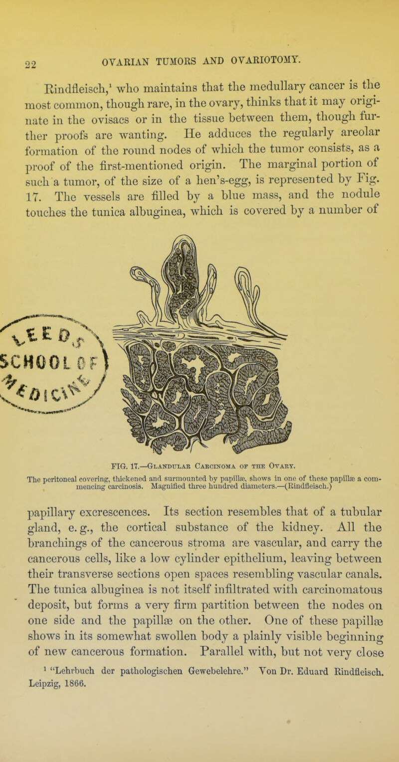 Rindfleisch,' wlio maintains that the medullarj cancer is the most common, though rare, in the ovary, thinks that it may origi- nate in the ovisacs or in the tissue between them, though fur- ther proofs are wanting. He adduces the regularly areolar formation of the round nodes of which the tumor consists, as a i:)roof of the first-mentioned origin. The marginal portion of such a tumor, of the size of a hen's-egg, is represented by Fig. 17. The vessels are filled by a blue mass, and the nodule touches the tunica albuginea, which is covered by a number of FIG. 17.—Glanditlar Carcinoma of the Ovary. The peritoneal covering, thickened and surmounted by papilla;, shows in one of these papillte a com- mencing carcinosis. Magnified three hundred diameters.—(Rindfleisch.) papillary excrescences. Its section resembles that of a tubular gland, e. g., the cortical substance of the kidney. All the branchings of the cancerous stroma are vascular, and carry the cancerous cells, like a low cylinder epithelium, leaving between their transverse sections open spaces resembling vascular canals. The tunica albuginea is not itself infiltrated with carcinomatous deposit, but forms a very firm partition between the nodes on one side and the papillae on the other. One of these papillna shows in its somewhat swollen body a plainly visible beginning of new cancerous formation. Parallel with, but not very close * Lehrbuch der pathologischen Gewebelehre. Von Dr. Eduard Rindfleisch. Leipzig, 1866.