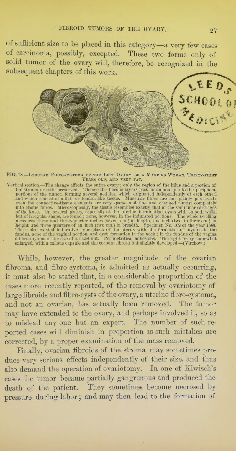 of sufficient size to be placed in tliis category—a very few cases of carcinoma, possibly, excepted. These two forms only of solid tumor of tlie ovary will, therefore, be recognized in the subsequent chapters of this work. _ FIG. 18.—Lobular Fibeo-ctstoma of the Left Ovary of a Married Woman, Thirty-eight Years old, and very fat. Vertical section.—Tlie chanfye affects the entire ovary; only the reg'ion of the hilns arid a portion of the stroma are stiil preserved. Thence the fibrous layers pass continuously into the periphera, portions of the tumor, forming several nodules, which origuiated independently of each otherl and which consist of a felt- or tendon-like tissue. Muscular fibres are not plainly perceived; even the connective-tissue elements arc very sparse and fine, and changed almost completely into elastic fibres. Microscopically, the tissue resembles exactly that of the semilunar cartilages of the knee. On several pLaces, especially at the uterine termination, cysts with smooth walls, but of irregular shape, are found ; none, however, in the indurated portions. The whole swelling measures three and three-quarter inches (seven cm.) in length, one inch (two to three cm.) in height, and three quarters of an inch (two cm.) in breadth. Specimen No. 102 of the year 1S63. There also existed indurative hyperplasia of the uterus with the formation of myoma in the fundus, acne of the v.aginal portion, and cyst formation in the neck; in the fundus of the vagina a fibro-myoma of the size of a hazel-nut. Perimetritical adhesions. The right ovary somewhat enlarged,with a callous capsule and the corpora fibrosa but slightly developed.—(Vu-chow.) While, however, the greater magnitude of the ovarian fibroma, and fibro-cystoma, is admitted as actually occurring, it must also be stated that, in a considerable proportion of the cases more recently reported, of the removal by ovariotomy of large fibroids and fibro-cysts of the ovary, a uterine fibro-cystoma, and not an ovarian, has actually been removed. Tlie tumor may have extended to the ovary, and perhaps involved it, so as to mislead any one but an expert. The number of such re- ported cases will diminish in proportion as such mistakes are corrected, by a proper examination of the mass removed. Finally, ovarian fibroids of the stroma may sometimes pro- duce very serious effects independently of their size, and thus also demand the operation of ovariotomy. In one of Kiwisch's cases the tumor became partially gangrenous and produced the death of the patient. They sometimes become necrosed by pressure during labor; and may then lead to the formation of