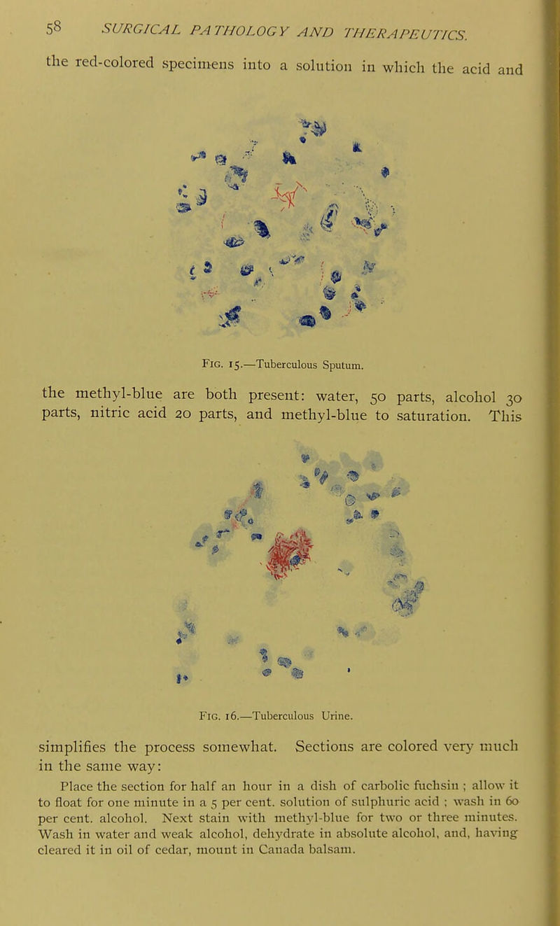 the red-colored specimens into a solution in which the acid and Fig. 15.—Tuberculous Sputum. the methyl-blue are both present: water, 50 parts, alcohol 30 parts, nitric acid 20 parts, and methyl-blue to saturation. This 1 0 Fig. 16.—Tuberculous Urine. simplifies the process somewhat. Sections are colored very much in the same way: Place the section for half an hour in a dish of carbolic fuchsiu ; allow it to float for one minute in a 5 per cent, solution of sulphuric acid ; wash in 60 per cent, alcohol. Next stain with methyl-blue for two or three minutes. Wash in water and weak alcohol, deh3'drate in absolute alcohol, and, having cleared it in oil of cedar, mount in Canada balsam.