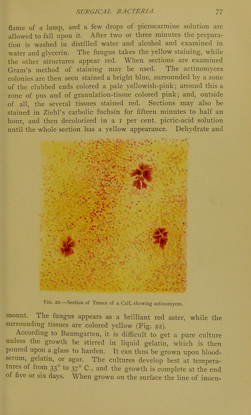 flame of a lamp, and a few drops of picrocarmine solution are allowed to fall upon it. After two or three minutes the prepara- tion is washed in distilled water and alcohol and examined in water and glycerin. The fungus takes the yellow staining, while the other structures appear red. When sections are examined Gram's method of staining may be used. The actinomyces colonies are then seen stained a bright blue, surrounded by a zone of the clubbed ends colored a pale yellowish-pink; around this a zone of pus and of granulation-tissue colored pink; and, outside of all, the several tissues stained red. Sections may also be stained in Ziehl's carbolic fuchsin for fifteen minutes to half an hour, and then decolorized in a i per cent, picric-acid solution until the whole section has a yellow appearance. Dehydrate and Fig. 22.—Section of Tumor of a Calf, showing actinomyces. mount. The fungus appears as a brilliant red aster, while the surrounding tissues are colored yellow (Fig. 22). According to Baumgarten, it is difficult to get a pure culture unless the growth be stirred in liquid gelatin, which is then poured upon a glass to harden. It can thus be grown upon blood- serum, gelatin, or agar. The cultures develop best at tempera- tures of from 33° to 37° C, and the growth is complete at the end of five or six days. When grown on the surface the line of inocu-