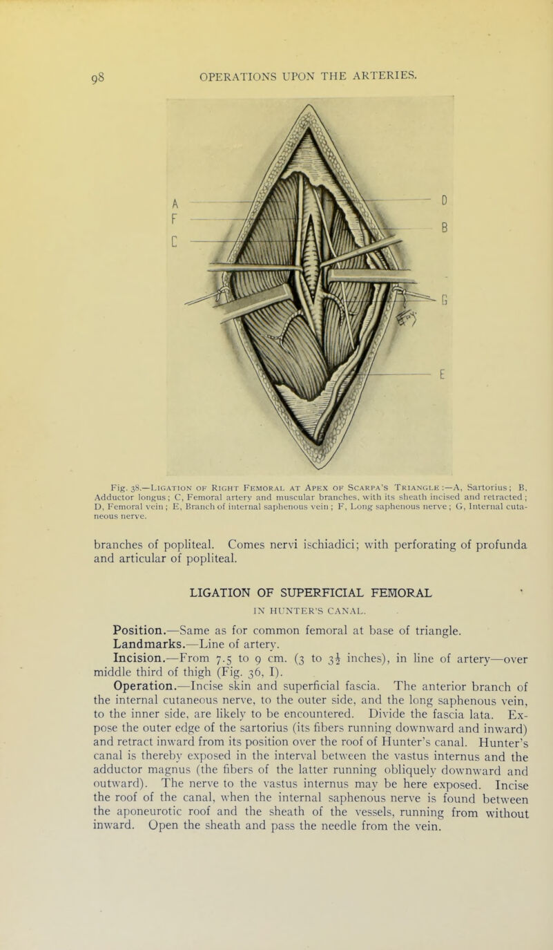 Fig-S^^-—Ligation of Right Femoral at Apex of Scarpa's Triangle :—A, Saitoiius; B, Adductor longus; C, Femoral artery and muscular branches, with its sheath incised and retracted ; D, Femoral vein ; E, Branch of internal saphenous vein ; F, Long saphenous nerve; G, Internal cuta- neous nerve. branches of popliteal. Comes nervi ischiadici; with perforating of profunda and articular of popliteal. LIGATION OF SUPERFICIAL FEMORAL IN HUNTER'S CANAL. Position.—Same as for common femoral at base of triangle. Landmarks.—Line of artery. Incision.—From 7.5 to 9 cm. (3 to 3^ inches), in line of artery—over middle third of thigh (Fig. 36, I). Operation.—Incise skin and superficial fascia. The anterior branch of the internal cutaneous nerve, to the outer side, and the long saphenous vein, to the inner side, are likely to be encountered. Divide the fascia lata. Ex- pose the outer edge of the sartorius (its fibers running downward and inward) and retract inward from its position over the roof of Hunter's canal. Hunter's canal is thereby exposed in the interval between the vastus internus and the adductor magnus (the fibers of the latter running obliquely downward and outward). The nerve to the vastus internus may be here exposed. Incise the roof of the canal, when the internal saphenous nerve is found between the aponeurotic roof and the sheath of the vessels, running from without inward. Open the sheath and pass the needle from the vein.