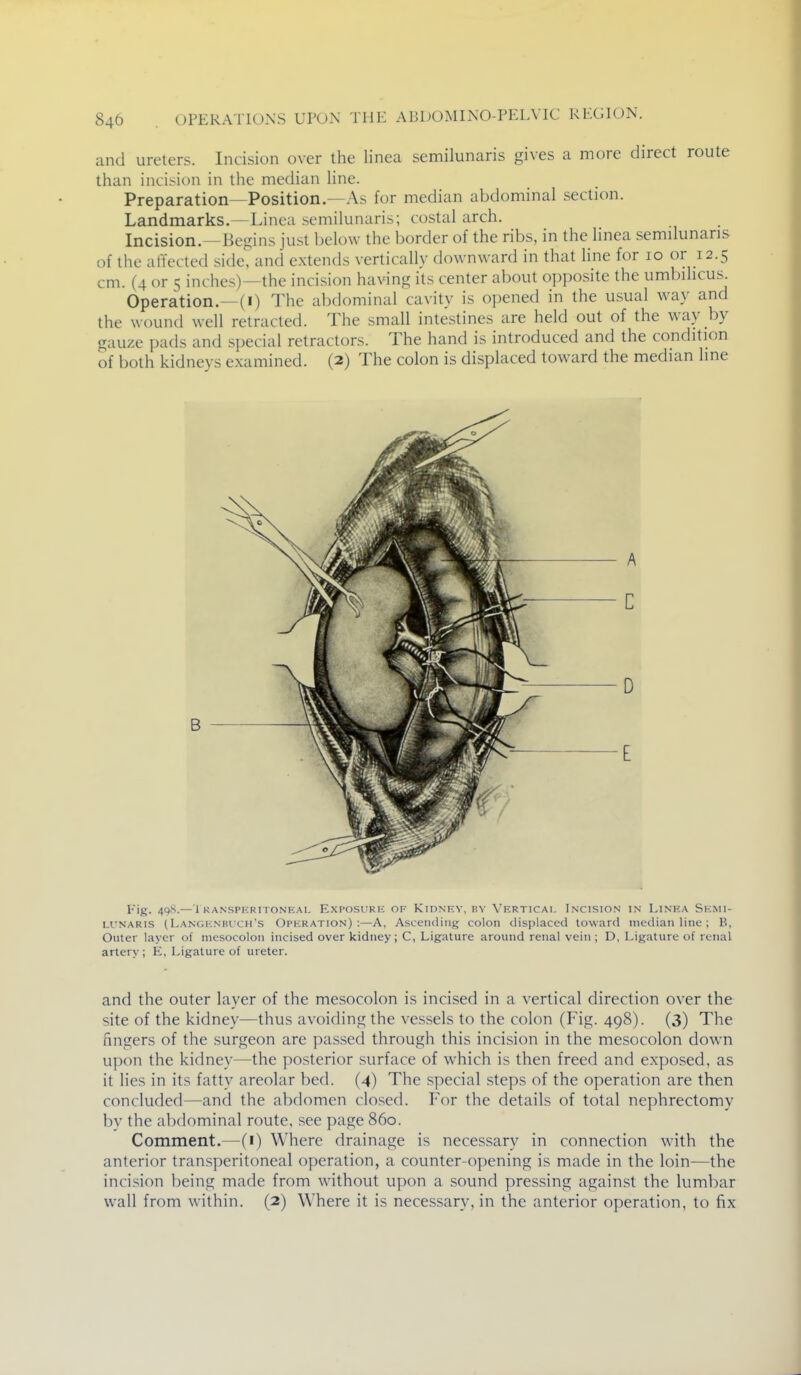 and ureters. Incision over the linea semilunaris gives a more direct route than inci<ic)n in the median line. Preparation—Position—As for median abdominal section. Landmarks.—Linea semilunaris; costal arch. Incision.—Begins just below the border of the ribs, in the linea semdunaris of the affected side, and extends vertically downward in that line for 10 or 12.5 cm. (4 or 5 inches)—the incision having its center about opposite the umbdicus. Operation.—(I) The abdominal cavity is opened in the usual way and the wound well retracted. The small intestines are held out of the way by gauze pads and special retractors. The hand is introduced and the condition of both kidneys examined. (2) The colon is displaced toward the median line B Fig. 4qS.—1 KANSPKRITONEAL EXPOSVIRK OF KiDNEV, BY VERTICAL INCISION IN LiNHA SEMI- LUNARIS ( Langknbich's Operation):—A, Ascetuiing colon displaced toward median line ; B, Outer layer of mesocolon incised over kidney; C, Ligature around renal vein ; D, Ligature of renal artery ; E, Ligature of ureter. and the outer layer of the mesocolon is incised in a vertical direction over the site of the kidney—thus avoiding the vessels to the colon (Fig. 498). (3) The fingers of the .surgeon are pas.sed through this incision in the mesocolon down upon the kidney—the posterior .surface of which is then freed and exposed, as it lies in its fatty areolar bed. (4) The special steps of the operation are then concluded—and the abdomen closed. For the details of total nephrectomy by the abdominal route, see page 860. Comment.—(1) Where drainage is necessary in connection wdth the anterior transperitoneal operation, a counter-opening is made in the loin—the incision being made from without upon a sound pressing against the lumbar wall from within. (2) Where it is necessary, in the anterior operation, to fix