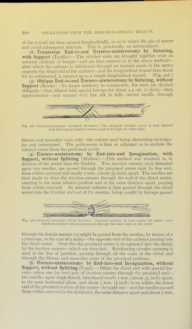 of the wound are then sutured longitudinally, so as to widen the site of suture and avoid subsequent stricture. This is, practically, an ureteroplasty. (2) Transverse End-to-end Uretero-ureterostomy by Suturing, with Support (Tauffer):—The divided ends are brought together over an ureteral catheter or bougie—and are tlien sutured as in the above method- after which the catheter is withdrawn through an incision made in the ureter opposite the distal end of the catheter—and the longitudinal wound thus made for its withdrawal, is sutured up as a simple longitudinal wound. (Fig. 508.) (3) Oblique End-to-end Uretero-ureterostomy by Suturing, without Support (IJovt'e):—To lessen tendency to contraction, the ends are divided obliquelv—then dilated with special forceps for about 2.5 cm. (i inch)—then approximated—and sutured wilh fine silk in fully curved needle, through Fig. 507.—Ureterorrhaphy without Si tport:—The obliquely divided ureter is seen sutured with interrupted Lembert sutures passed through the outer coals. fibrous and muscular coats only—the sutures used being alternating rectangu- lar and interrupted. The peritoneum is then so adjusted as to exclude the sutured ureter from the peritoneal cavity. (4) Uretero-ureterostomy by End-into-end Invagination, with Support, without Splitting (Markoe):—This method was resorted to in division of the ureter near the bladder. Two traction-sutures, each threaded upon two needles, are passed through the proximal ureter near its free end, from within outward and nearly 2 mm. (about inch) apart. The needles are then made to draw the traction-sutures through the wall of the distal ureter, entering in the same relative position and at the same distance apart, passing from within outward. An ureteral catheter is then passed through the distal ureter into the bladder and out of the meatus, being caught by forceps passed vM. Fig. 508.—Urktkkorrhai'HN- with Si ppokt :—Ureteral catheter is seen within the ureter, over which interrupted sutures are passed through the outer coats of the ureter. through the female meatus (or might be passed from the urethra, by means of a cystoscope, in the case of a male)—the opposite end of the catheter passing into the distal ureter. Over this the proximal ureter is invaginated into the distal, by the traction-sutures—which are then tied. Reinforcing circular suturing is used at the Hue of junction, passing through all the coats of the distal and through the fibrnus and musctdar coals of tlie proximal portions. (5) Uretero-ureterostomy by End-into-end Invagination, without Support, without Splitting (Poggi):—Dilate the distal end with special for- ceps—place one (or two) pair of traction-sutures through the proximal end— two needles upon single thread, introduced nearly 2 mm. (about -jV inch) apart, in the same horizontal plane, and about 3 mm. \\ inch) from within the lower end of the proximal portion of the ureter—brought out—and the needles passed from within outward in the distal end, the sam.e distance apart and about 7 mm.