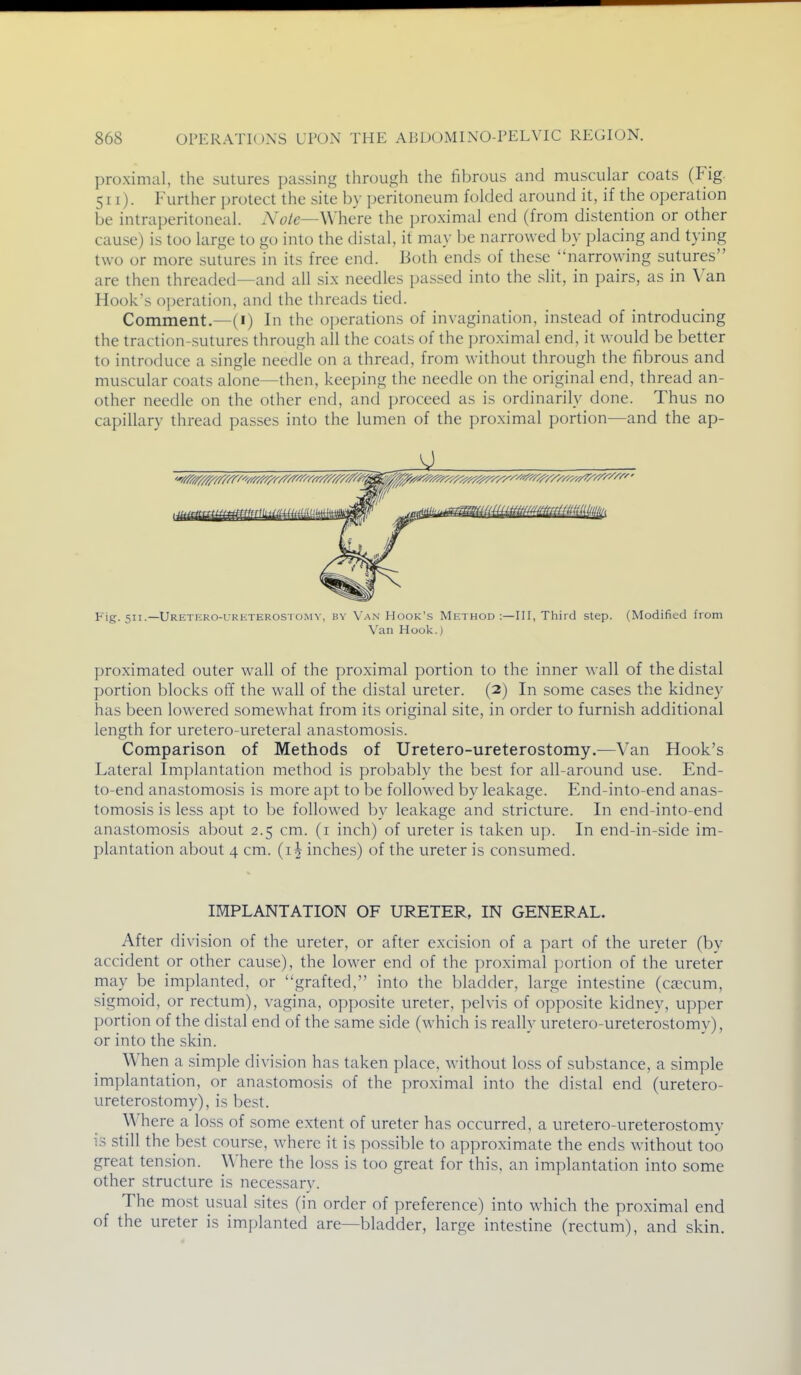 proximal, the sutures passing tiirough the fibrous and muscular coats (Fig. 511). Further protect the site by peritoneum folded around it, if the operation be intraperitoneal. A'oie—Where the proximal end (from distention or other cause) is too large to go into the distal, it may be narrowed by placing and tying two or more sutures in its free end. Both ends of these narrowing sutures are then threaded—and all six needles passed into the slit, in pairs, as in Van Hook's operation, and the threads tied. Comment.—(i) In the o])erations of invagination, instead of introducing the traction-sutures through all the coats of the proximal end, it would be better to introduce a single needle on a thread, from without through the fibrous and muscular coats alone—then, keeping the needle on the original end, thread an- other needle on the other end, and proceed as is ordinarily done. Thus no capillary thread passes into the lumen of the proximal portion—and the ap- Fig. 511.—URETiiRO-URETEROSTOMV, BY VanHook's METHOD:—III,Tliiid Step. (Modified from Van Hook.) proximated outer wall of the proximal portion to the inner wall of the distal portion blocks off the wall of the distal ureter. (2) In some cases the kidney has been lowered somewhat from its original site, in order to furnish additional lensfth for uretero-ureteral anastomo.sis. Comparison of Methods of Uretero-ureterostomy.—Van Hook's Lateral Implantation method is probably the best for all-around use. End- to-end anastomosis is more ajjt to be followed by leakage. End-into-end anas- tomosis is less apt to be followed by leakage and stricture. In end-into-end anastomosis about 2.5 cm. (i inch) of ureter is taken up. In end-in-side im- plantation about 4 cm. (i^ inches) of the ureter is consumed. IMPLANTATION OF URETER, IN GENERAL. After division of the ureter, or after excision of a part of the ureter (by accident or other cause), the lower end of the proximal portion of the ureter may be implanted, or grafted, into the bladder, large intestine (caecum, sigmoid, or rectum), vagina, opposite ureter, pelvis of opposite kidney, upper portion of the distal end of the same side (which is really uretero-ureterostomy), or into the skin. When a simple division has taken place, without loss of substance, a simple implantation, or anastomosis of the proximal into the distal end (uretero- ureterostomy), is best. Where a loss of some extent of ureter has occurred, a uretero-ureterostomv is still the best course, where it is possible to approximate the ends without too great tension. \Miere the loss is too great for this, an implantation into some other structure is necessarv. The most usual sites (in order of preference) into which the proximal end of the ureter is implanted are—bladder, large intestine (rectum), and skin.