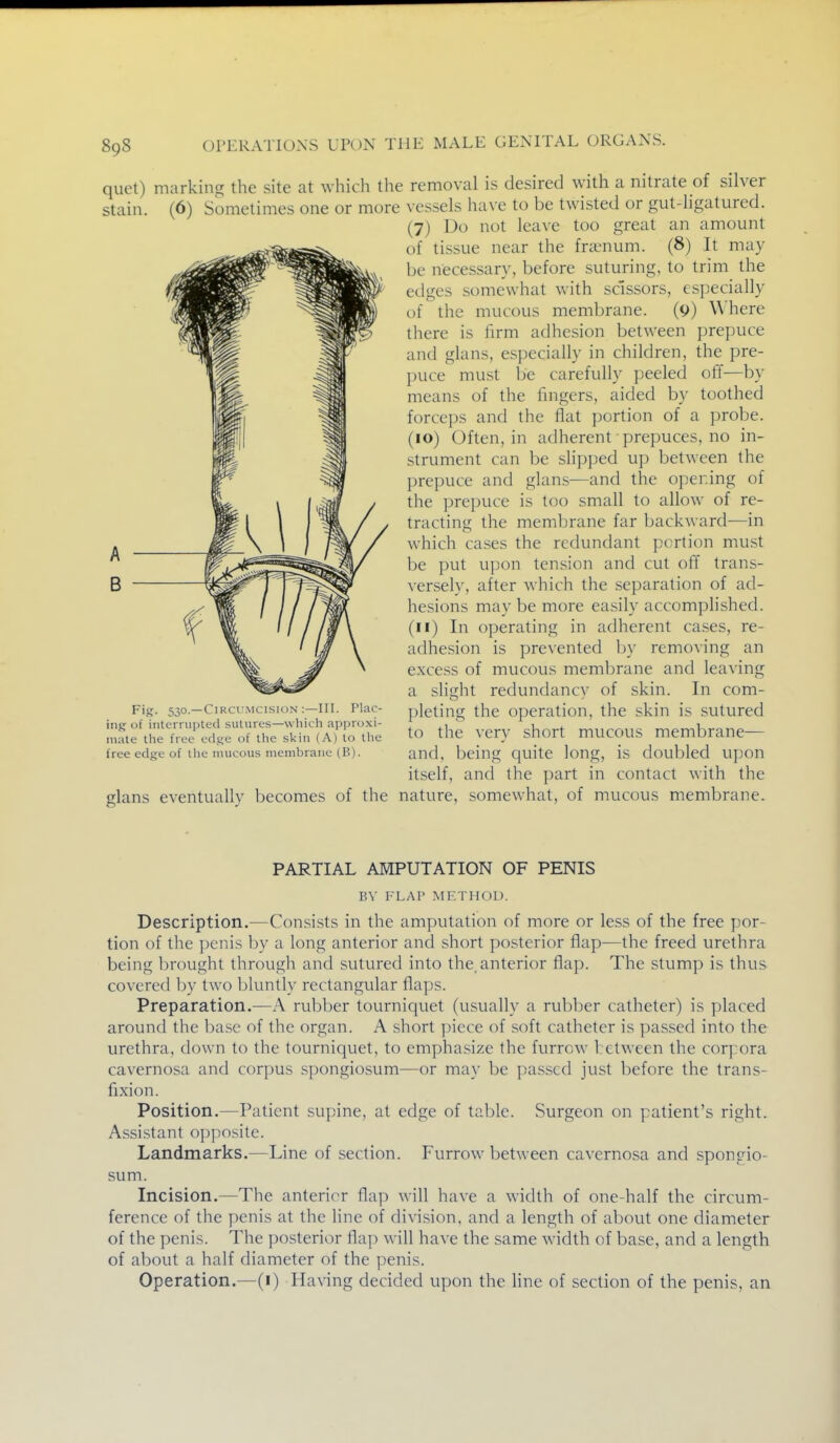 quet) marking the site at which the removal is desired with a nitrate of silver stain. (6) Sometimes one or more vessels have to be twisted or gut-ligatured. (7) Do not leave too great an amount of tissue near the fra?num. (8) It may be necessary, before suturing, to trim the edges somewhat with scissors, especially of the mucous membrane. (9) Where there is firm adhesion between prepuce and glans, especially in children, the pre- puce must be carefully peeled off—by means of the fingers, aided by toothed forceps and the flat portion of a probe. (10) Often, in adherent prepuces, no in- strument can be slipped up between the prepuce and glans—and the opening of the prepuce is too small to allow of re- tracting the membrane far backward—in which cases the redundant portion must be put upon tension and cut off trans- versely, after which the separation of ad- hesions may be more easily accomplished. (11) In operating in adherent cases, re- adhesion is prevented by removing an excess of mucous membrane and leaving a slisiht redundancv of skin. In com- pleting the operation, the skin is sutured to the very short mucous membrane— and, being quite long, is doubled upon itself, and the part in contact with the glans eventually becomes of the nature, somewhat, of mucous membrane. A B Fig. 530.—CiRCl'MCisioN :—ni. Plac- ing of interrupted sutures—wliich approxi- mate tlie free edge of tlie skiti (A) to llie free edge of tlie mucous membrane (B). PARTIAL AMPUTATION OF PENIS BV FLAP METHOD. Description.—Consists in the amputation of more or less of the free por- tion of the penis by a long anterior and short posterior flap—the freed urethra being brought through and sutured into the, anterior flap. The stump is thus covered by two l:)luntly rectangular flaps. Preparation.—A rubber tourniquet (usually a rubber catheter) is placed around the ba.se of the organ. A short piece of soft catheter is passed into the urethra, down to the tourniquet, to emphasize the furrow between the corpora cavernosa and corpus spongiosum—or may be passed just before the trans- fixion. Position.—Patient supine, at edge of table. Surgeon on patient's right. Assistant opposite. Landmarks.—Line of section. Furrow between cavernosa and spongio- sum. Incision.—The anterior flap will have a width of one-half the circum- ference of the penis at the line of division, and a length of about one diameter of the penis. The posterior flap will have the same width of base, and a length of about a half diameter of the penis. Operation.—(1) Having decided upon the Hne of section of the penis, an