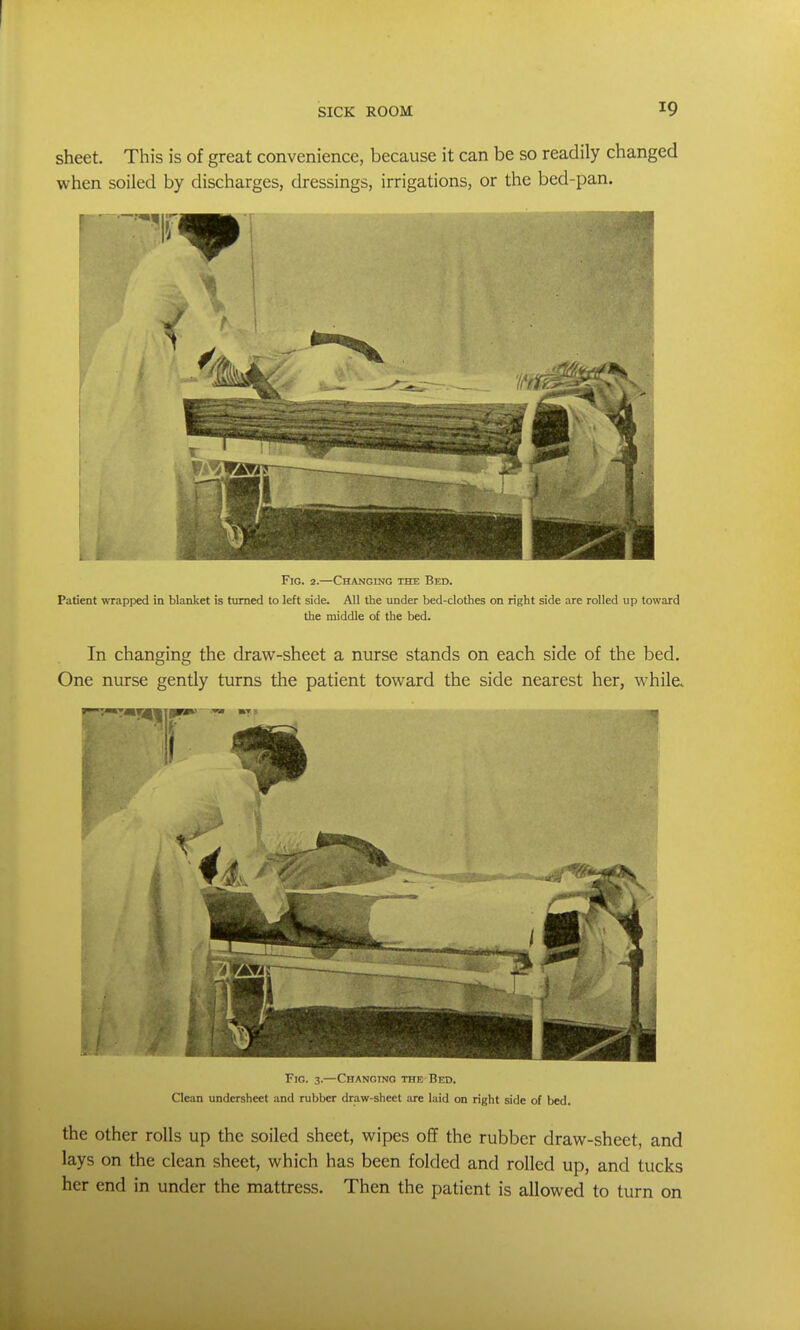 sheet. This is of great convenience, because it can be so readily changed when soiled by discharges, dressings, irrigations, or the bed-pan. Fig. 2.—Changing the Bed. Patient wrapped in blanket is turned to left side. All the under bed-clothes on right side are rolled up toward the middle of the bed. In changing the draw-sheet a nurse stands on each side of the bed. One nurse gently turns the patient toward the side nearest her, while. Fig. 3.—Changing the Bed. Clean undersheet and rubber draw-sheet are laid on right side of bed. the Other rolls up the soiled sheet, wipes off the rubber draw-sheet, and lays on the clean sheet, which has been folded and rolled up, and tucks her end in under the mattress. Then the patient is allowed to turn on