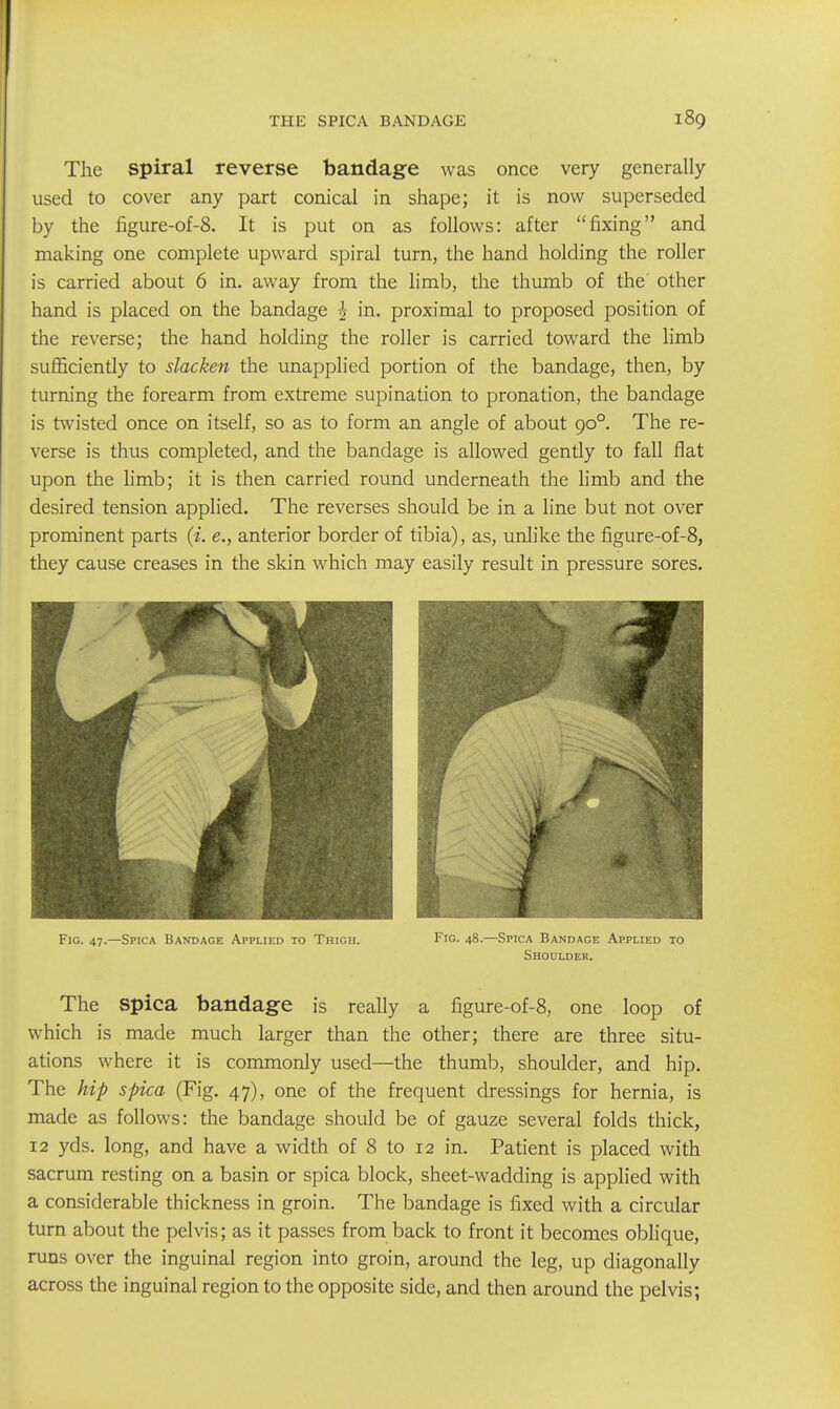 The Spiral reverse bandage was once very generally used to cover any part conical in shape; it is now superseded by the figure-of-8. It is put on as follows: after fixing and making one complete upward spiral turn, the hand holding the roller is carried about 6 in. away from the limb, the thumb of the other hand is placed on the bandage ^ in. proximal to proposed position of the reverse; the hand holding the roller is carried toward the limb suflSciently to slacken the unapplied portion of the bandage, then, by turm'ng the forearm from extreme supination to pronation, the bandage is twisted once on itself, so as to form an angle of about 90°. The re- verse is thus completed, and the bandage is allowed gently to fall flat upon the limb; it is then carried round underneath the limb and the desired tension applied. The reverses should be in a line but not over prominent parts {i. e., anterior border of tibia), as, unlike the figure-of-8, they cause creases in the skin which may easily result in pressure sores. The spica bandage is really a figure-of-8, one loop of which is made much larger than the other; there are three situ- ations where it is commonly used—the thumb, shoulder, and hip. The hip spica (Fig, 47), one of the frequent dressings for hernia, is made as follows: the bandage should be of gauze several folds thick, 12 yds. long, and have a width of 8 to 12 in. Patient is placed with sacrum resting on a basin or spica block, sheet-wadding is applied with a considerable thickness in groin. The bandage is fixed with a circular turn about the pelvis; as it passes from back to front it becomes oblique, runs over the inguinal region into groin, around the leg, up diagonally across the inguinal region to the opposite side, and then around the pelvis; Fig. 47.—Spica Bandage Applied to Thigh. Fig. 48.—Spica Bandage Applied to Shoulder.