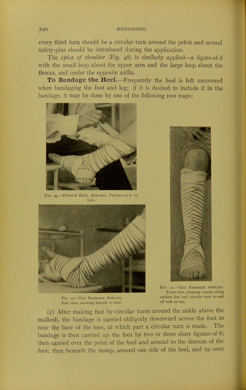 every third turn should be a circular turn around the pelvis and several safety-pins should be introduced during the application. The spica of shoulder (Fig. 48) is similarly applied—a figure-of-8 with the small loop about the upper arm and the large loop about the thorax, and under the opposite axilla. To Bandage the Heel.—Frequently the heel is left uncovered when bandaging the foot and leg; if it is desired to include it in the bandage, it may be done by one of the following two ways: Fig. so.—Leg Bandage Applied. median line and circular turn to end Side view, showing testudo to heel. off with at top. (i) After making fast by circular turns around the ankle above the malleoli, the bandage is carried obliquely downward across the foot to near the base of the toes, at which part a circular turn is made. The bandage is then carried up the foot by two or three short figures-of-8; then carried over the point of the heel and around to the dorsum of the foot; then beneath the instep, around one side of the heel, and up over