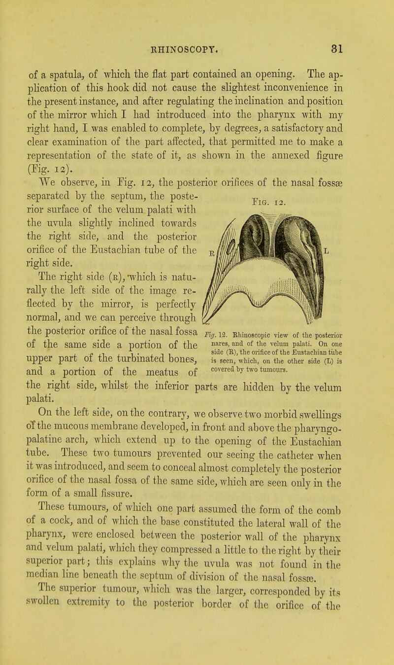 Tig. 12. of a spatula, of which the flat part contained an opening. The ap- plication of this hook did not cause the slightest inconvenience in the present instance, and after regulating the inclination and position of the mirror which I had introduced into the pharynx with my right hand, I was enabled to complete, by degrees, a satisfactory and clear examination of the part affected, that permitted me to make a representation of the state of it, as shown in the annexed figure (Fig. 12). We observe, in Fig. 12, the posterior orifices of the nasal fossae separated by the septum, the poste- rior surface of the velum palati with the uvula slightly inclined towards the right side, and the posterior orifice of the Eustachian tube of the right side. The right side (r), -which is natu- rally the left side of the image re- flected by the mirror, is perfectly normal, and we can perceive through the posterior orifice of the nasal fossa of the same side a portion of the upper part of the turbinated bones, and a portion of the meatus of the right side, whilst the inferior parts are liidden by the velum palati. On the left side, on the contrary, we observe two morbid swellings of the mucous membrane developed, in front and above the pharyngo- palatine arch, which extend up to the opening of the Eustacliian tube. These two tumours prevented our seeing the catheter when it was introduced, and seem to conceal almost completely the posterior orifice of the nasal fossa of the same side, which are seen only in the form of a small fissure. These tumours, of wliich one part assumed the form of the comb of a cock, and of which the base constituted the lateral wall of the pharynx, were enclosed between the posterior wall of the pharynx and velum palati, which they compressed a little to the right by their superior part; tliis explains why the uvula was not found 'in the median line beneath the septum of division of the nasal foss£e. The superior tumour, which was the larger, corresponded by its swollen extremity to the posterior border of the orifice of the Fii;. 12. Rhinoscopic view of tlie posterior nares, aud of tlie velum palati. On one side (B), the orifice of the Eustachian tiibe is seen, wliich, on the other side (L) is covered by two tumours.