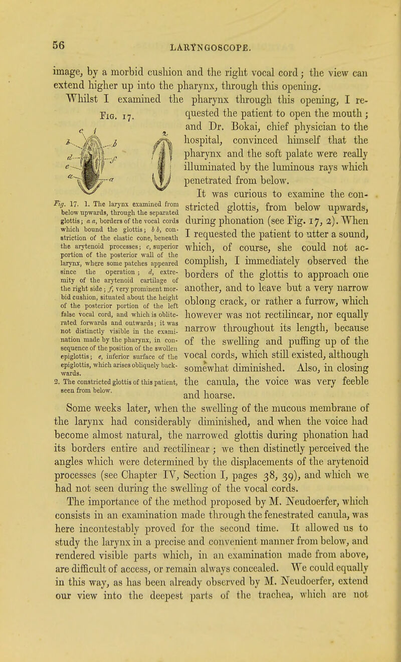 image, by a morbid cusliion and the right vocal cord; the view can extend higher up into the pharynx, through this opening. Whilst I examined the pharynx through this opening, I re- YiG. 17. quested the patient to open the mouth ; and Dr. Bokai, chief physician to the hospital, convinced himself that the pharynx and the soft palate were really illuminated by the luminous rays which penetrated from below. It was curious to examine the cou- % 17. 1. The larynx examined fiom gtricted glottis, from below upwards, below upwards, through the separated . . . glottis; a a. borders of the vocal cords during pllOUation (sCC Pig. 17, 2,). When wliich bound the glottis; ii, con- t j.Ji.1 i Btriction of the elastic co^e. beneath I requested the patient to utter a sound, the arytenoid processes; c, superior wllicll, of COUTSC, she COuld UOt aC- portion of tlie posterior wall of the . t , 1 i tii larynx, where some patches appeared COmpilSh, i immediately ObserVCd the since the operation; d extre- borders of the glottis to approach one mity of the arytenoid cartilage of 1 i i the right side; ^, very prominent mor- anotlicr, aud to leavc but a Very uarrow T^f^'^:t^!^ oblong crack, or railier a furrow, which false vocal cord, and which is obhte- liowever was iiot rectilinear, nor equally rated forwards and outwards; it was ,1 ^ x i ii 1 not distinctly ,'isibie in tlie exami- narrow throughout its length, because nation made by the pharynx, in con- of the swelling and pufuig Up of tllC sequence of the position of the swollen - - ,T, .,, . , -, , , , epiglottis; e, inferior siufaee of the VOCai COrds, whicll stlll CXlstcd, althOUgil epiglottis, which arises obhquely back- gomcwhat diminished. Also, in closing 3. The constricted glottis of this patient, the cauula, the voice was Very feeble seen from below. t i and hoarse. Some weeks later, when the swelling of the mucous membrane of the larynx had considerably diminished, and when the voice had become almost natural, the narrowed glottis during plionation had its borders entire and rectilinear ; we then distinctly perceived the angles which were determined by the displacements of the arytenoid processes (see Chapter IV, Section I, pages 38, 39), and wliich we had not seen during the swelling of the vocal cords. The importance of the method proposed by M. Neudoerfer, which consists in an examination made tlii'ough the fenestrated canula, was here incontestably proved for the second time. It allowed us to study the larynx in a precise and convenient manner from beloAv, and rendered visible parts which, in an examination made from above, are difficult of access, or remain always concealed. We could equally in this way, as has been already observed by M. Neudoerfer, extend our view into the deepest parts of the trachea, which are not