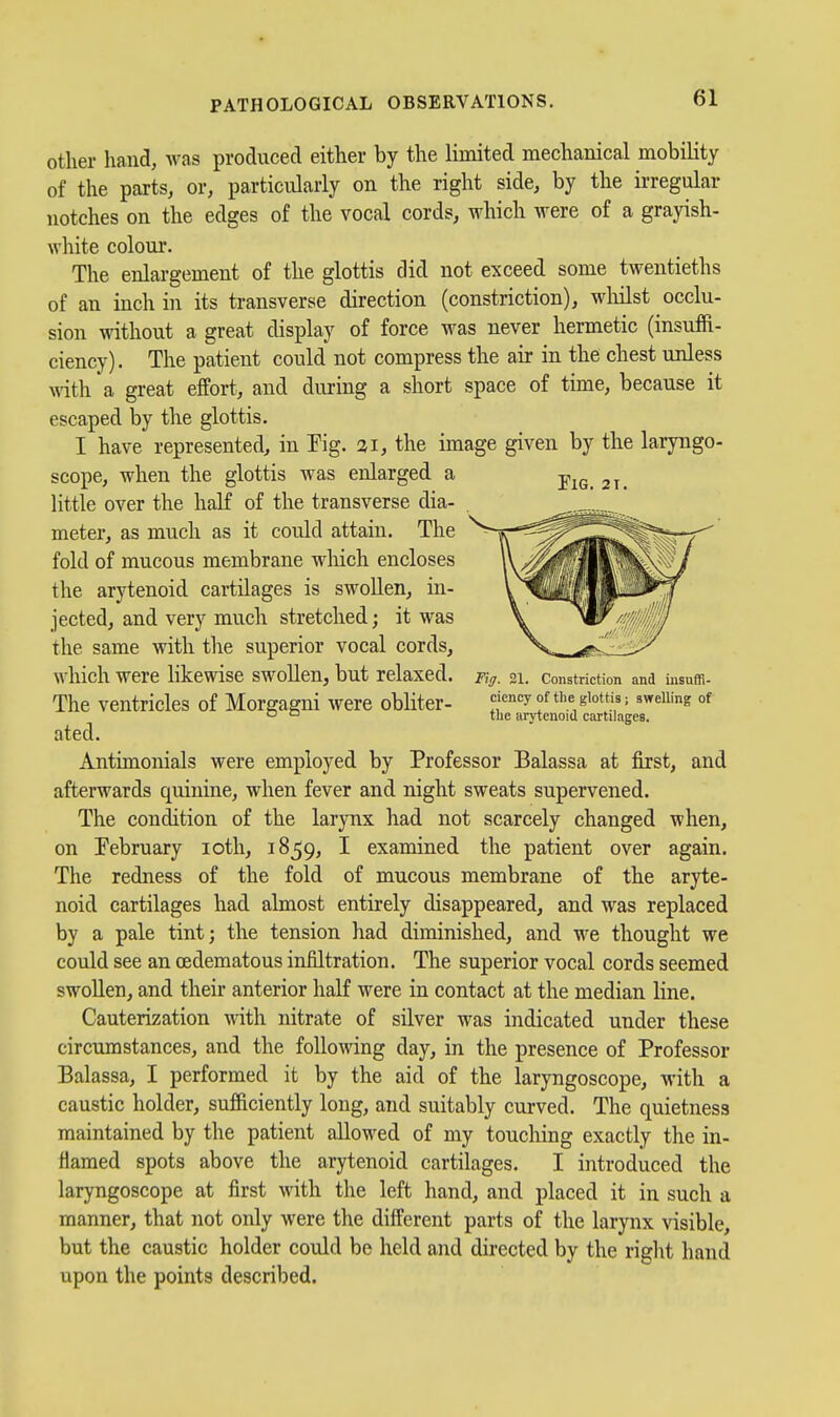 otlier hand, was produced either by the limited mechanical mobility of the parts, or, particularly on the right side, by the irregular notches on the edges of the vocal cords, which were of a grayish- white colour. The enlargement of the glottis did not exceed some twentieths of an inch in its transverse direction (constriction), wliilst occlu- sion without a great display of force was never hermetic (insuffi- ciency). The patient could not compress the air in the chest unless with a great effort, and during a short space of time, because it escaped by the glottis. I have represented, in Fig. 31, the image given by the laryngo- scope, when the glottis was enlarged a 21. little over the half of the transverse dia- meter, as much as it could attain. The fold of mucous membrane which encloses the arytenoid cartilages is swollen, in- jected, and very much stretched; it was the same with the superior vocal cords, which were likewise swollen, but relaxed. Fig. 31. Constriction and insufli- The ventricles of Morgagni were obliter- cicncy of the glottis; swelling of ° ° tlie arytenoid cartilages. ated. Antimonials were employed by Professor Balassa at first, and afterwards quinine, when fever and night sweats supervened. The condition of the larynx had not scarcely changed when, on Tebruary loth, 1859, I examined the patient over again. The redness of the fold of mucous membrane of the aryte- noid cartilages had almost entirely disappeared, and was replaced by a pale tint; the tension had diminished, and we thought we could see an oedematous infiltration. The superior vocal cords seemed swoUen, and their anterior half were in contact at the median line. Cauterization vAi\\ nitrate of silver was indicated under these circumstances, and the following day, in the presence of Professor Balassa, I performed it by the aid of the laryngoscope, with a caustic holder, sufficiently long, and suitably curved. The quietness maintained by the patient allowed of my touching exactly the in- flamed spots above the arytenoid cartilages. I introduced the laryngoscope at first with the left hand, and placed it in such a manner, that not only were the different parts of the larynx visible, but the caustic holder could be held and directed by the riglit hand upon the points described.