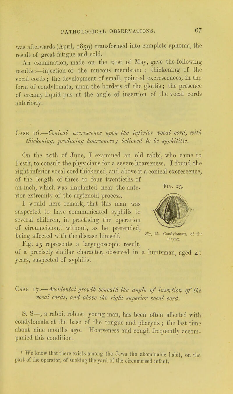 was afterwards (April, 1859) transformed into complete aphonia, the result of great fatigue and cold. An examination, made on the 21st of May, gave the following results :—injection of the mucous membrane; thickening of the vocal cords j the development of small, pointed excrescences, in the form of condylomata, upon the borders of the glottis; the presence of creamy licpiid pus at the angle of insertion of the vocal cords anteriorly. Case 16.—Conical excrescence upon the inferior vocal cord, loith tJiickeninff, producing Jioarseness; believed to be syphilitic. On the aotli of June, I examined an old rabbi, Avho came to Pesth, to consult the physicians for a severe hoarseness. I found the right inferior vocal cord thickened, and above it a conical excrescence, of the length of three to four twentieths of an inch, which was implanted near the ante- rior extrcjnity of the arytenoid process. I would here remark, that this man was suspected to have communicated sj^jhiHs to several cliildren, in practising the operation of circumcision,' without, as lie pretended, being affected with the disease himseK. Pig. 25 represents a laryngoscopic result, of a precisely similar character, observed in a huntsman, aged 41 years, suspected of sypliilis. Condylomata of tlie Inrvnx. Case 17.—Accidental (jro%oth beneath the angle of insertion of the vocal cords, and above the light superior vocal cord. S. S—, a rabbi, robust young man, lias been often affected with condylomata at the base of tlie tongue and pharynx; the last time about nine months ago. Hoarseness and cough frequently accom- panied this condition. ' We know that there exists among the .Tows the abominable hal)it, on the part of the operator, of sucking the yard of the eircumciscd infant.