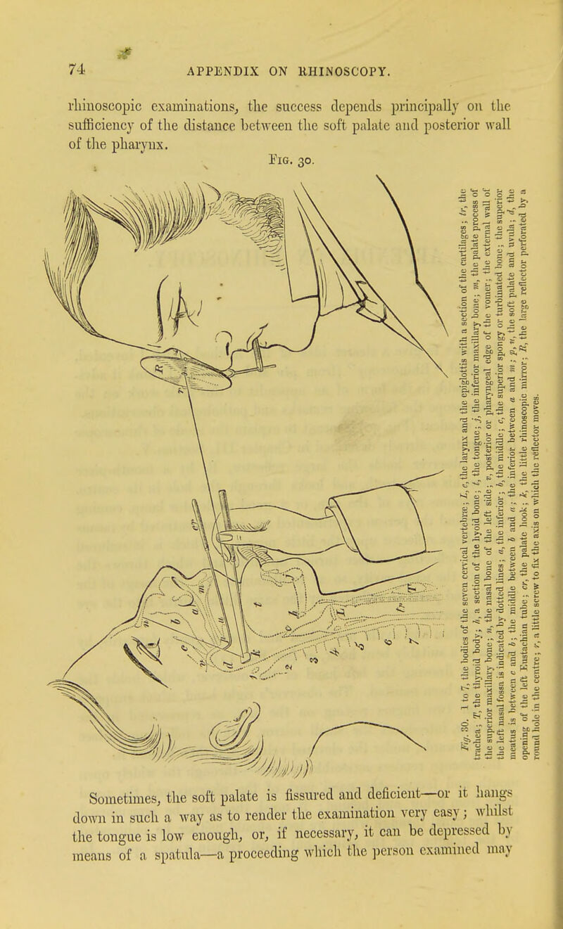 rliinoscopic examinations^ the success depends principally on the sufficiency of the distance between the soft palate and posterior wall of the pharynx. Tig. 30. Sometimes, the soft palate is fissured and deficient—or it hangs down in such a way as to render the examination very easy; whilst the tongue is low enough, or, if necessary, it can be depressed by means of a spatula—a proceeding which the person examined may