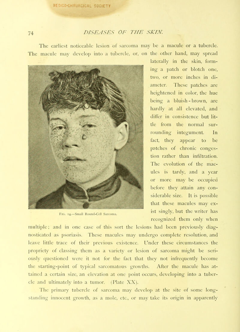 74 The earliest noticeable lesion of sarcoma may be a macule or a tubercle. The macule may develop into a tubercle, or, on the other hand, may spread laterally in the skin, form- ing a patch or blotch one, two, or more inches in di- ameter. These patches are heightened in color, the hue being a bluish - brown, are hardly at all elevated, and differ in consistence but lit- tle from the normal sur- rounding integument. In fact, they appear to be patches of chronic conges- tion rather than infiltration. The evolution of the mac- ules is tardy, and a year or more may be occupied before they attain any con- siderable size. It is possible that these macules may ex- ist singly, but the writer has recognized them only when multiple; and in one case of this sort the lesions had been previously diag- nosticated as psoriasis. These macules may undergo complete resolution, and leave little trace of their previous existence. Under these circumstances the propriety of classing them as a variety or lesion of sarcoma might be seri- ously questioned were it not for the fact that they not infrequently become the starting-point of typical sarcomatous growths. After the macule has at- tained a certain size, an elevation at one point occurs, developing into a tuber- cle and ultimately into a tumor. (Plate XX). The primary tubercle of sarcoma may develop at the site of some long- standing innocent growth, as a mole, etc., or may take its origin in apparently Fig. 14.—Small Round-Cell Sarcoma.