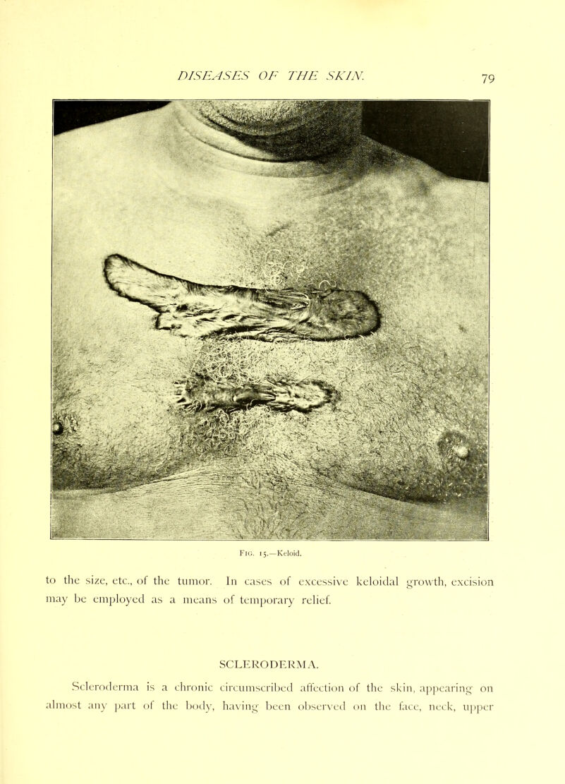 Fig. 15.—Keloid. to the size, etc., of the tumor. In cases of excessive keloidal growth, excision may be employed as a means of temporary relief. SCLERODERMA. Scleroderma is almost any part of a chronic circumscribed affection of the skin, appearing on the body, having been observed on the face, neck, upper