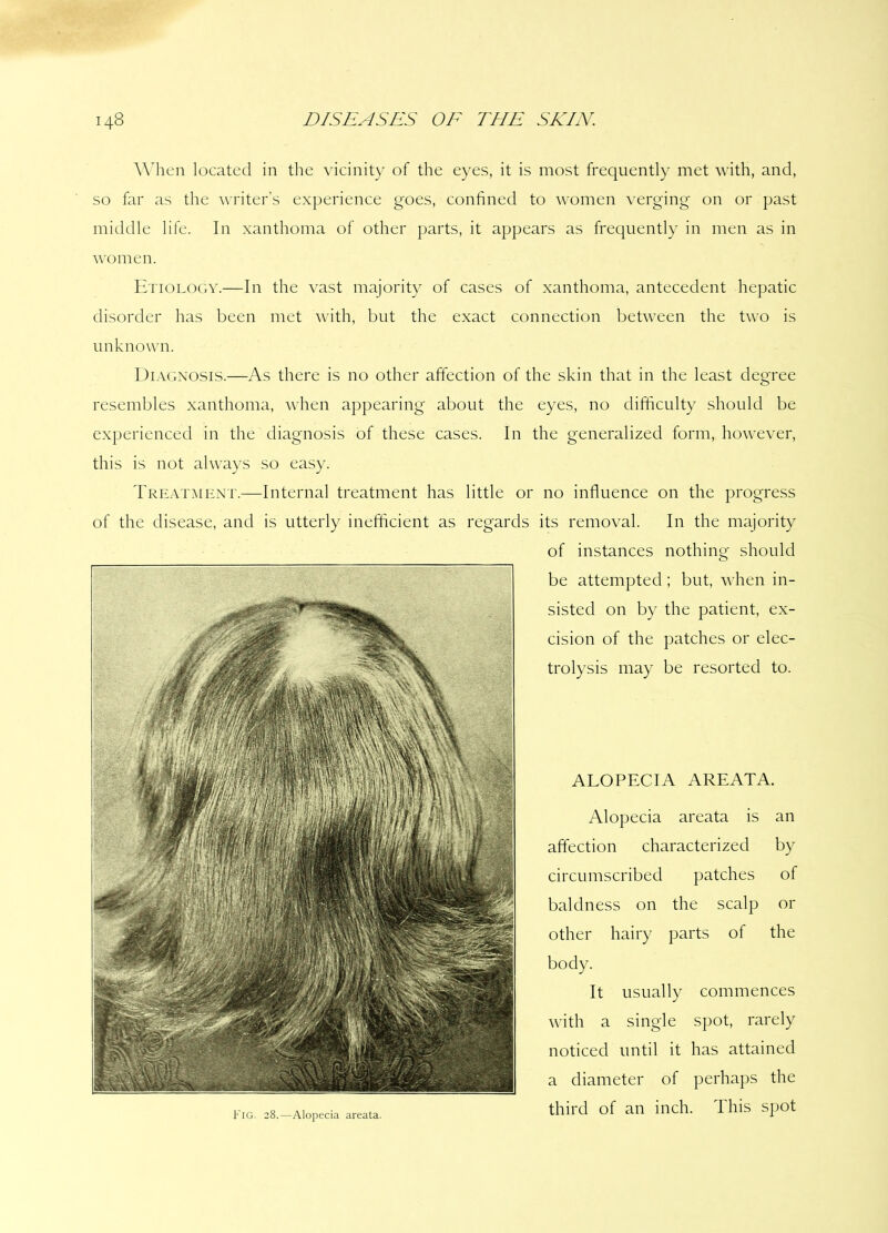 When located in the vicinity of the eyes, it is most frequently met with, and, so far as the writer’s experience goes, confined to women verging on or past middle life. In xanthoma of other parts, it appears as frequently in men as in women. Etiology.—In the vast majority of cases of xanthoma, antecedent hepatic disorder has been met with, but the exact connection between the two is unknown. Diagnosis.—As there is no other affection of the skin that in the least degree resembles xanthoma, when appearing about the eyes, no difficulty should be experienced in the diagnosis of these cases. In the generalized form, however, this is not always so easy. Treatment.—Internal treatment has little or no influence on the progress of the disease, and is utterly inefficient as regards its removal. In the majority of instances nothing should be attempted ; but, when in- sisted on by the patient, ex- cision of the patches or elec- trolysis may be resorted to. Fig. 28.—Alopecia areata. ALOPECIA AREATA. Alopecia areata is an affection characterized by circumscribed patches of baldness on the scalp or other hairy parts of the body. It usually commences with a single spot, rarely noticed until it has attained a diameter of perhaps the third of an inch. This spot