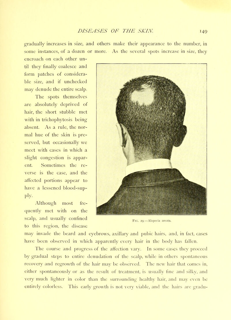 gradually increases in size, and others make their appearance to the number, in some instances, of a dozen or more. As the several spots increase in size, they encroach on each other un- til they finally coalesce and form patches of considera- ble size, and if unchecked may denude the entire scalp. The spots themselves are absolutely deprived of hair, the short stubble met with in trichophytosis being absent. As a rule, the nor- mal hue of the skin is pre- served, but occasionally we meet with cases in which a slight congestion is appar- ent. Sometimes the re- verse is the case, and the affected portions appear to have a lessened blood-sup- ply. Although most fre- quently met with on the scalp, and usually confined to this region, the disease may invade the beard and eyebrows, axillary and pubic hairs, and, in fact, cases have been observed in which apparently every hair in the body has fallen. The course and progress of the affection vary. In some cases they proceed by gradual steps to entire denudation of the scalp, while in others spontaneous recovery and regrowth of the hair may be observed. The new hair that comes in, either spontaneously or as the result of treatment, is usually fine and silky, and very much lighter in color than the surrounding healthy hair, and may even be entirely colorless. This early growth is not very viable, and the hairs are gradu-