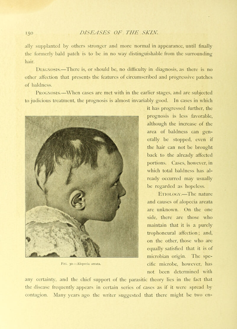 ally supplanted by others stronger and more normal in appearance, until finally the formerly bald patch is to be in no way distinguishable from the surrounding hair. Diagnosis.—There is, or should be, no difficulty in diagnosis, as there is no other affection that presents the features of circumscribed and progressive patches of baldness. Prognosis.—When cases are met with in the earlier stages, and are subjected to judicious treatment, the prognosis is almost invariably good. In cases in which it has progressed further, the prognosis is less favorable, although the increase of the area of baldness can gen- erally be stopped, even if the hair can not be brought back to the already affected portions. Cases, however, in which total baldness has al- ready occurred may usually be regarded as hopeless. Etiology.—The nature and causes of alopecia areata are unknown. On the one side, there are those who maintain that it is a purely trophoneural affection; and, on the other, those who are equally satisfied that it is of microbian origin. The spe- cific microbe, however, has not been determined with any certainty, and the chief support of the parasitic theory lies in the fact that the disease frequently appears in certain series of cases as if it were spread by contagion. Many years ago the writer suggested that there might be two en-