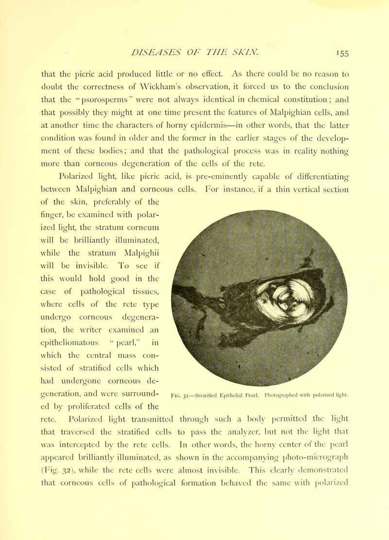that the picric acid produced little or no effect. As there could be no reason to doubt the correctness of Wickham’s observation, it forced us to the conclusion that the “ psorosperms ” were not always identical in chemical constitution ; and that possibly they might at one time present the features of Malpighian cells, and at another time the characters of horny epidermis—in other words, that the latter condition was found in older and the former in the earlier stages of the develop- ment of these bodies; and that the pathological process was in reality nothing more than corneous degeneration of the cells of the rete. Polarized light, like picric acid, is pre-eminently capable of differentiating between Malpighian and corneous cells. For instance, if a thin vertical section of the skin, preferably of the finger, be examined with polar- ized light, the stratum corneum will be brilliantly illuminated, while the stratum Malpighii will be invisible. To see if this would hold good in the case of pathological tissues, where cells of the rete type undergo corneous degenera- tion, the writer examined an epitheliomatous “ pearl,” in which the central mass con- sisted of stratified cells which had undergone corneous de- generation, and Were Sllliound- FIG. 32.—Stratified Epithelial Pearl. Photographed with polarized light. ed by proliferated cells of the rete. Polarized light transmitted through such a body permitted the light that traversed the stratified cells to pass the analyzer, but not the light that was intercepted by the rete cells. In other words, the horny center of the pearl appeared brilliantly illuminated, as shown in the accompanying photo-micrograph (Fig. 32), while the rete cells were almost invisible. This clearly demonstrated that corneous cells of pathological formation behaved the same with polarized