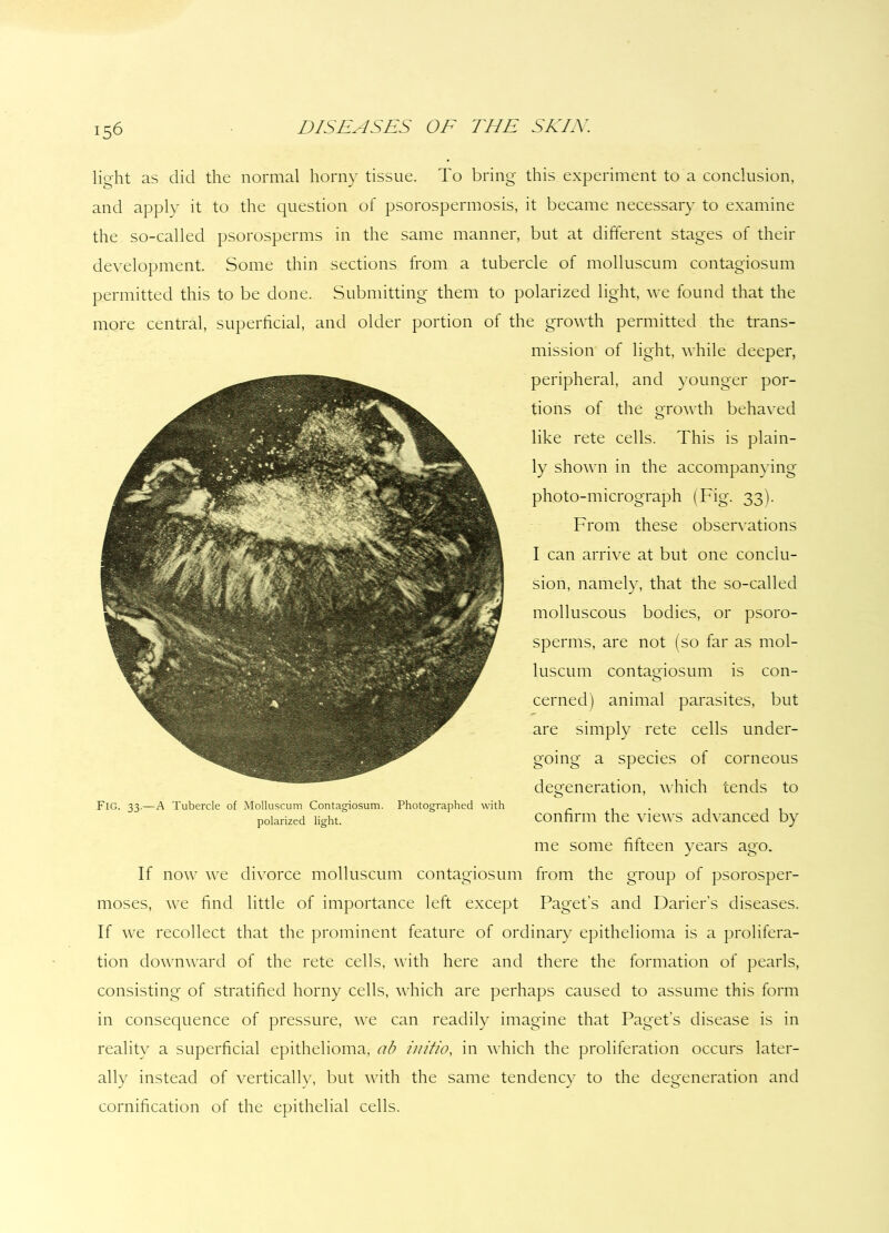 light as did the normal horny tissue. To bring this experiment to a conclusion, and apply it to the question of psorospermosis, it became necessary to examine the so-called psorosperms in the same manner, but at different stages of their development. Some thin sections from a tubercle of molluscum contagiosum permitted this to be done. Submitting them to polarized light, we found that the more central, superficial, and older portion of the growth permitted the trans- mission of light, while deeper, peripheral, and younger por- tions of the growth behaved like rete cells. This is plain- ly shown in the accompanying photo-micrograph (Fig. 33). From these observations I can arrive at but one conclu- sion, namely, that the so-called molluscous bodies, or psoro- sperms, are not (so far as mol- luscum contagiosum is con- cerned) animal parasites, but are simply rete cells under- going a species of corneous degeneration, which tends to confirm the views advanced by me some fifteen years ago. If now we divorce molluscum contagiosum from the group of psorosper- moses, we find little of importance left except Paget's and Darier’s diseases. If we recollect that the prominent feature of ordinary epithelioma is a prolifera- tion downward of the rete cells, with here and there the formation of pearls, consisting of stratified horny cells, which are perhaps caused to assume this form in consequence of pressure, we can readily imagine that Paget's disease is in reality a superficial epithelioma, ab initio, in which the proliferation occurs later- ally instead of vertically, but with the same tendency to the degeneration and cornification of the epithelial cells. Fig. 33.—A Tubercle of Molluscum Contagiosum. polarized light. Photographed with