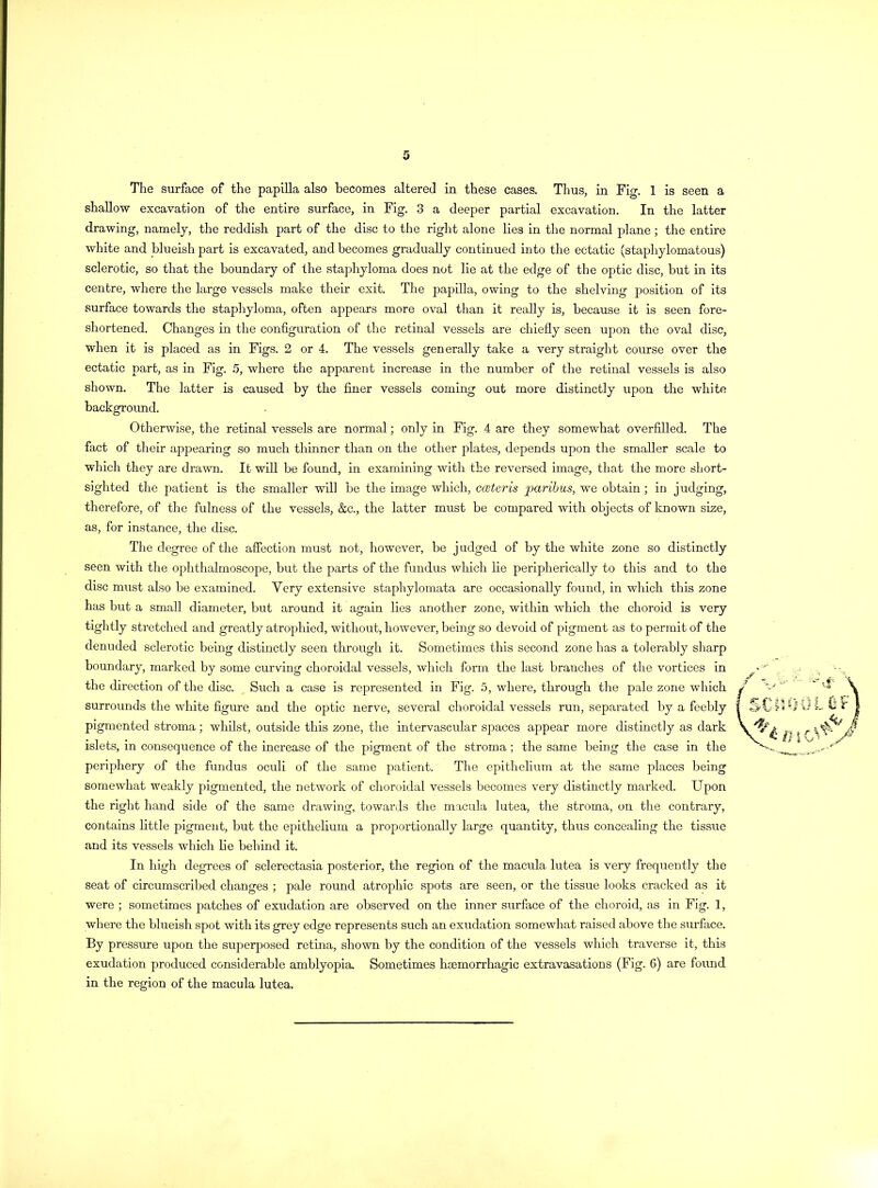 The surface of the papilla also becomes altered in these cases. Thus, in Fig. 1 is seen a shallow excavation of the entire surface, in Fig. 3 a deeper partial excavation. In the latter drawing, namely, the reddish part of the disc to the right alone lies in the normal plane; the entire white and blueish part is excavated, and becomes gradually continued into the ectatic (staphylomatous) sclerotic, so that the boundary of the staphyloma does not lie at the edge of the optic disc, but in its centre, where the large vessels make their exit. The papilla, owing to the shelving position of its surface towards the staphyloma, often appears more oval than it really is, because it is seen fore- shortened. Changes in the configuration of the retinal vessels are chiefly seen upon the oval disc, when it is placed as in Figs. 2 or 4. The vessels generally take a very straight course over the ectatic part, as in Fig. 5, where the apparent increase in the number of the retinal vessels is also shown. The latter is caused by the finer vessels coming out more distinctly upon the white background. Otherwise, the retinal vessels are normal; only in Fig. 4 are they somewhat overfilled. The fact of their appearing so much thinner than on the other plates, depends upon the smaller scale to which they are drawn. It will be found, in examining with the reversed image, that the more short- sighted the patient is the smaller will be the image which, cceteris paribus, we obtain ; in judging, therefore, of the fulness of the vessels, &c., the latter must be compared with objects of known size, as, for instance, the disc. The degree of the affection must not, however, be judged of by the white zone so distinctly seen with the ophthalmoscope, but the parts of the fundus which lie peripherically to this and to the disc must also be examined. Very extensive staphylomata are occasionally found, in which this zone has but a small diameter, but around it again lies another zone, within which the choroid is very tightly stretched and greatly atrophied, without, however, being so devoid of pigment as to permit of the denuded sclerotic being distinctly seen through it. Sometimes this second zone has a tolerably sharp boundary, marked by some curving choroidal vessels, which form the last branches of the vortices in the direction of the disc. Such a case is represented in Fig. 5, where, through the pale zone which surrounds the white figure and the optic nerve, several choroidal vessels run, separated by a feebly pigmented stroma; whilst, outside this zone, the intervascular spaces appear more distinctly as dark islets, in consequence of the increase of the pigment of the stroma; the same being the case in the periphery of the fundus oculi of the same patient. The epithelium at the same places being somewhat weakly pigmented, the network of choroidal vessels becomes very distinctly marked. Upon the right hand side of the same drawing, towards the macula lutea, the stroma, on the contrary, contains little pigment, but the epithelium a proportionally large quantity, thus concealing the tissue and its vessels which lie behind it. In high degrees of sclerectasia posterior, the region of the macula lutea is very frequently the seat of circumscribed changes ; pale round atrophic spots are seen, or the tissue looks cracked as it were ; sometimes patches of exudation are observed on the inner surface of the choroid, as in Fig. 1, where the blueish spot with its grey edge represents such an exudation somewhat raised above the surface. By pressure upon the superposed retina, shown by the condition of the vessels which traverse it, this exudation produced considerable amblyopia. Sometimes haemorrhagic extravasations (Fig. 6) are found in the region of the macula lutea.