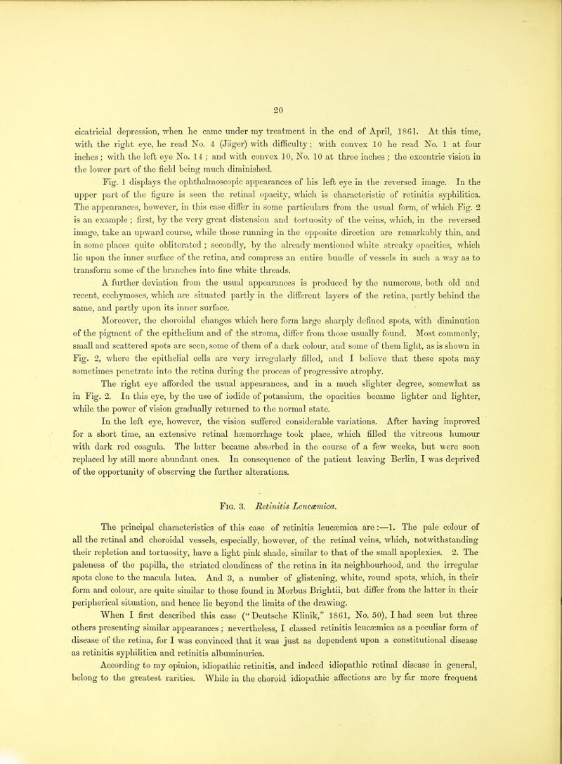 cicatricial depression, when he came under my treatment in the end of April, 1861. At this time, with the right eye, he read No. 4 (Jiiger) with difficulty; with convex 10 he read No. 1 at four inches; with the left eye No. 14 ; and with convex 10, No. 10 at three inches ; the excentric vision in the lower part of the field being much diminished. Fig. 1 displays the ophthalmoscopic appearances of his left eye in the reversed image. In the upper part of the figure is seen the retinal opacity, which is characteristic of retinitis syphilitica. The appearances, however, in this case differ in some particulars from the usual form, of which Fig. 2 is an example ; first, by the very great distension and tortuosity of the veins, which, in the reversed image, take an upward course, while those running in the opposite direction are remarkably thin, and in some places quite obliterated ; secondly, by the already mentioned white streaky opacities, which lie upon the inner surface of the retina, and compress an entire bundle of vessels in such a way as to transform some of the branches into fine white threads. A further deviation from the usual appearances is produced by the numerous, both old and recent, ecchymoses, which are situated partly in the different layers of the retina, partly behind the same, and partly upon its inner surface. Moreover, the choroidal changes which here form large sharply defined spots, with diminution of the pigment of the epithelium and of the stroma, differ from those usually found. Most commonly, small and scattered spots are seen, some of them of a dark colour, and some of them light, as is shown in Fig. 2, where the epithelial cells are very irregularly filled, and I believe that these spots may sometimes penetrate into the retina during the process of progressive atrophy. The right eye afforded the usual appearances, and in a much slighter degree, somewhat as in Fig. 2. In this eye, by the use of iodide of potassium, the opacities became lighter and lighter, while the power of vision gradually returned to the normal state. In the left eye, however, the vision suffered considerable variations. After having improved for a short time, an extensive retinal haemorrhage took place, which filled the vitreous humour with dark red coagula. The latter became absorbed in the course of a few weeks, but were soon replaced by still more abundant ones. In consequence of the patient leaving Berlin, I was deprived of the opportunity of observing the further alterations. Fig. 3. Retinitis Leucamica. The principal characteristics of this case of retinitis leucaemica are :—1. The pale colour of all the retinal and choroidal vessels, especially, however, of the retinal veins, which, notwithstanding their repletion and tortuosity, have a light pink shade, similar to that of the small apoplexies. 2. The paleness of the papilla, the striated cloudiness of the retina in its neighbourhood, and the irregular spots close to the macula lutea. And 3, a number of glistening, white, round spots, which, in their form and colour, are quite similar to those found in Morbus Brightii, but differ from the latter in their peripherical situation, and hence lie beyond the limits of the drawing. When I first described this case (“Deutsche Klinik,” 1861, No. 50), I had seen but three others presenting similar appearances ; nevertheless, I classed retinitis leucgemica as a peculiar form of disease of the retina, for I was convinced that it was just as dependent upon a constitutional disease as retinitis syphilitica and retinitis albuminurica. According to my opinion, idiopathic retinitis, and indeed idiopathic retinal disease in general, belong to the greatest rarities. While in the choroid idiopathic affections are by far more frequent