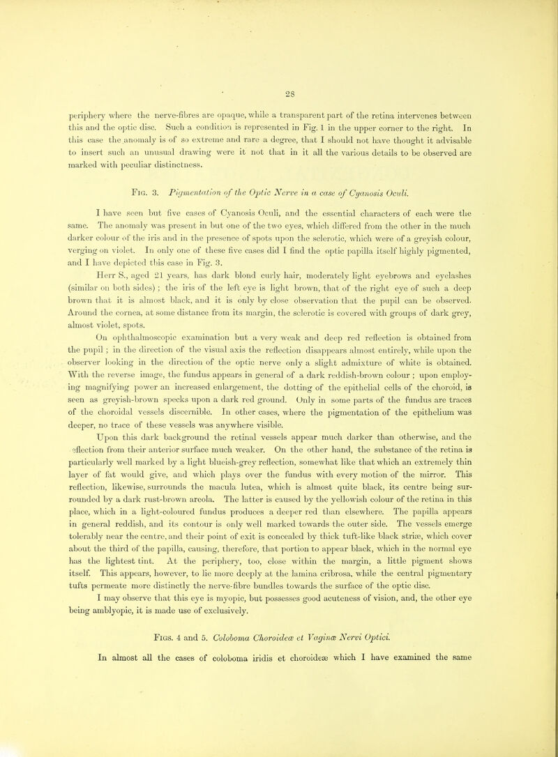 periphery where the nerve-fibres are opaque, while a transparent part of the retina intervenes between this and the optic disc. Such a condition is represented in Fig. 1 in the upper corner to the right. In this case the.anomaly is of so extreme and rare a degree, that I should not have thought it advisable to insert such an unusual drawing were it not that in it all the various details to be observed are marked with peculiar distinctness. Fig. 3. Pigmentation of the Optic Nerve in a case of Cyanosis Ocnli. I have seen but five cases of Cyanosis Oculi, and the essential characters of each were the same. The anomaly was present in but one of the two eyes, which differed from the other in the much darker colour of the iris and in the presence of spots upon the sclerotic, which were of a greyish colour, verging on violet. In only one of these five cases did I find the optic papilla itself highly pigmented, and I have depicted this case in Fig. 3. Herr S., aged 21 years, has dark blond curly hair, moderately light eyebrows and eyelashes (similar on both sides) ; the iris of the left eye is light brown, that of the right eye of such a deep brown that it is almost black, and it is only by close observation that the pupil can be observed. Around the cornea, at some distance from its margin, the sclerotic is covered with groups of dark grey, almost violet, spots. On ophthalmoscopic examination but a very weak and deep red reflection is obtained from the pupil ; in the direction of the visual axis the reflection disappears almost entirely, while upon the observer looking in the direction of the optic nerve only a slight admixture of white is obtained. With the reverse image, the fundus appears in general of a dark reddish-brown colour ; upon employ- ing magnifying power an increased enlargement, the dotting of the epithelial cells of the choroid, is seen as greyish-brown specks upon a dark red ground. Only in some parts of the fundus are traces of the choroidal vessels discernible. In other cases, where the pigmentation of the epithelium was deeper, no trace of these vessels was anywhere visible. Upon this dark background the retinal vessels appear much darker than otherwise, and the eflection from their anterior surface much weaker. On the other hand, the substance of the retina is particularly well marked by a light blueish-grey reflection, somewhat like that which an extremely thin layer of fat would give, and which plays over the fundus with every motion of the mirror. This reflection, likewise, surrounds the macula lutea, which is almost quite black, its centre being sur- rounded by a dark rust-brown areola. The latter is caused by the yellowish colour of the retina in this place, which in a light-coloured fundus produces a deeper red than elsewhere. The papilla appears in general reddish, and its contour is only well marked towards the outer side. The vessels emerge tolerably near the centre, and their point of exit is concealed by thick tuft-like black striae, which cover about the third of the papilla, causing, therefore, that portion to appear black, which in the normal eye has the lightest tint. At the periphery, too, close within the margin, a little pigment shows itself. This appears, however, to lie more deeply at the lamina cribrosa, while the central pigmentary tufts permeate more distinctly the nerve-fibre bundles towards the surface of the optic disc. I may observe that this eye is myopic, but possesses good acuteness of vision, and, the other eye being amblyopic, it is made use of exclusively. Figs. 4 and 5. Colohoma Choroidece et Vagince Nervi Optici. In almost all the cases of colohoma iridis et choroideae which I have examined the same