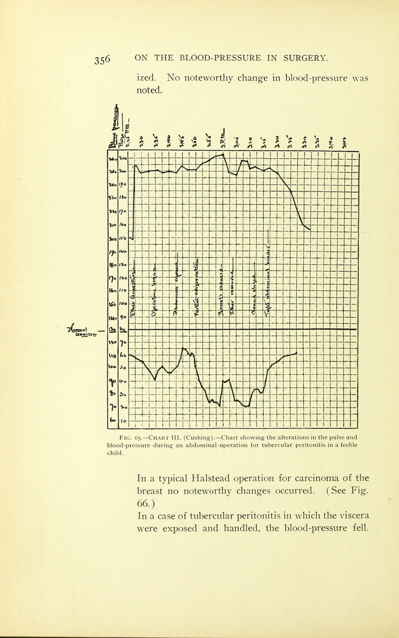 ized. No noteworthy change in blood-pressure was noted. Fig. 65.—Chart HI. (Cushing).—Chart showing the alterations in the pulse and blood-pressure during an abdominal operation for tubercular peritonitis in a feeble child. In a typical Halstead operation for carcinoma of the breast no noteworthy changes occurred. (See Fig. 66.) In a case of tubercular peritonitis in which the viscera were exposed and handled, the blood-pressure fell.