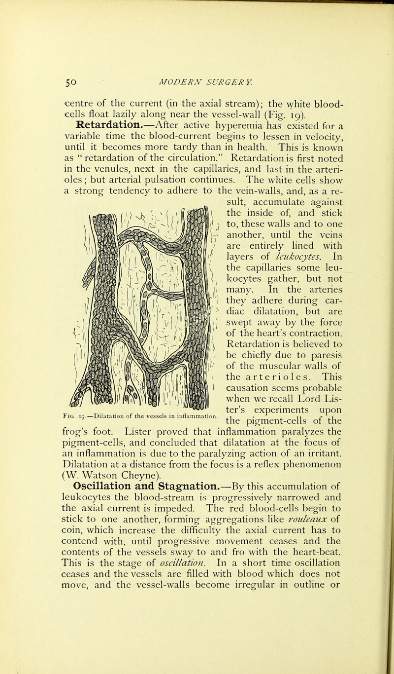 centre of the current (in the axial stream); the white blood- cells float lazily along near the vessel-wall (Fig. 19). Retardation.—After active hyperemia has existed for a variable time the blood-current begins to lessen in velocity, until it becomes more tardy than in health. This is known as  retardation of the circulation. Retardation is first noted in the venules, next in the capillaries, and last in the arteri- oles ; but arterial pulsation continues. The white cells show a strong tendency to adhere to the vein-walls, and, as a re- sult, accumulate against the inside of, and stick to, these walls and to one another, until the veins are entirely lined with layers of leukocytes. In the capillaries some leu- kocytes gather, but not many. In the arteries they adhere during car- diac dilatation, but are swept away by the force of the heart's contraction. Retardation is believed to be chiefly due to paresis of the muscular walls of the arterioles. This causation seems probable when we recall Lord Lis- ter's experiments upon the pigment-cells of the frog's foot. Lister proved that inflammation paralyzes the pigment-cells, and concluded that dilatation at the focus of an inflammation is due to the paralyzing action of an irritant. Dilatation at a distance from the focus is a reflex phenomenon (W. Watson Cheyne). Oscillation and Stagnation.—By this accumulation of leukocytes the blood-stream is progressively narrowed and the axial current is impeded. The red blood-cells begin to stick to one another, forming aggregations like roiilemix of coin, which increase the difficulty the axial current has to contend with, until progressive movement ceases and the contents of the vessels sway to and fro with the heart-beat. This is the stage of oscillation. In a short time oscillation ceases and the vessels are filled with blood which does not move, and the vessel-walls become irregular in outline or Fig. 19.—Dilatation of the vessels in inflammation.