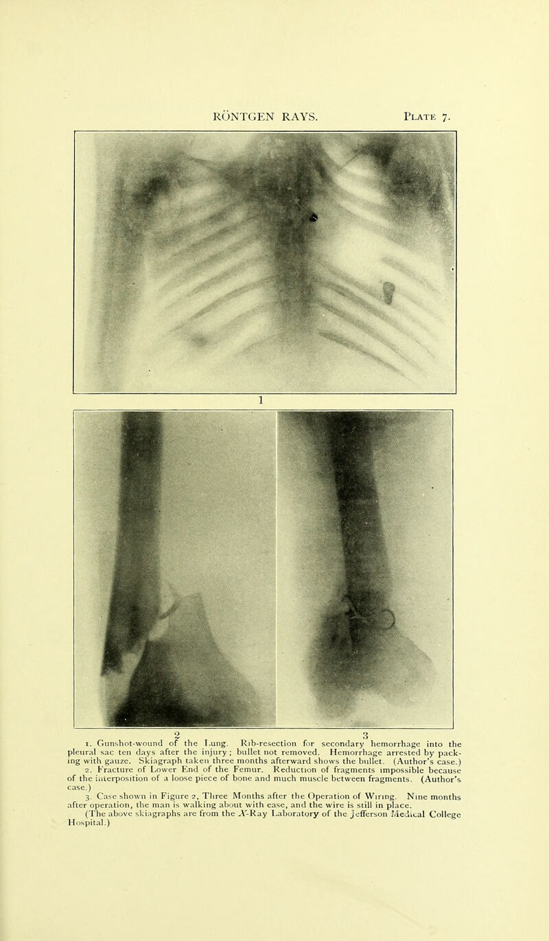 1. Gunshot-wound of the Lung. Rib-resection fir secondary hemorrhage into the pleural sac ten days after the injury; bullet not removed. Hemorrhage arrested by pack- ing with gauze. Skiagraph taken three months afterward shows the bullet. (Author's case.) 2. Fracture of Lower End of the Femur. Reduction of fragments impossible because of the iiiterposition of a loose piece of bone and much muscle between fragments. (Author's case.) 3. Case shown in Figure 2, Three Months after the Operation of Wiring. Nine months after operation, the man is walking about with ease, and the wire is still in place. (The above skiagraphs are from the A'-Ray Laboratory of the Jefferson Medical College Hospital.)