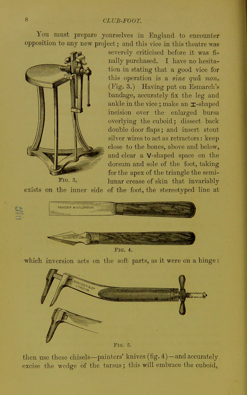 You must prepare yourselves in England to encounter opposition to any new project; and this vice in this theatre was severely criticised before it was fi- nally purchased. I have no hesita- tion in stating that a good vice for this operation is a sine qua non. (Fig. 3.) Having put on Esmarch's bandage, accurately fix the leg and ankle in the vice; make an x-shaped incision over the enlarged bursa overlying the cuboid; dissect back double door flaps; and insert stout silver wires to act as retractors: keep close to the bones, above and below, and clear a V-shaped space on the dorsum and sole of the foot, taking for the apex of the triangle the semi- ^'icf- 3- lunar crease of skin that invariably exists on the inner side of the foot, the stereotyped line at SAVICNY fcU; LONDON- - -^^ Fig. 5. then use these chisels—painters' knives (fig. 4)—and accurately excise the wedge of the tarsus; this will embrace the cuboid.