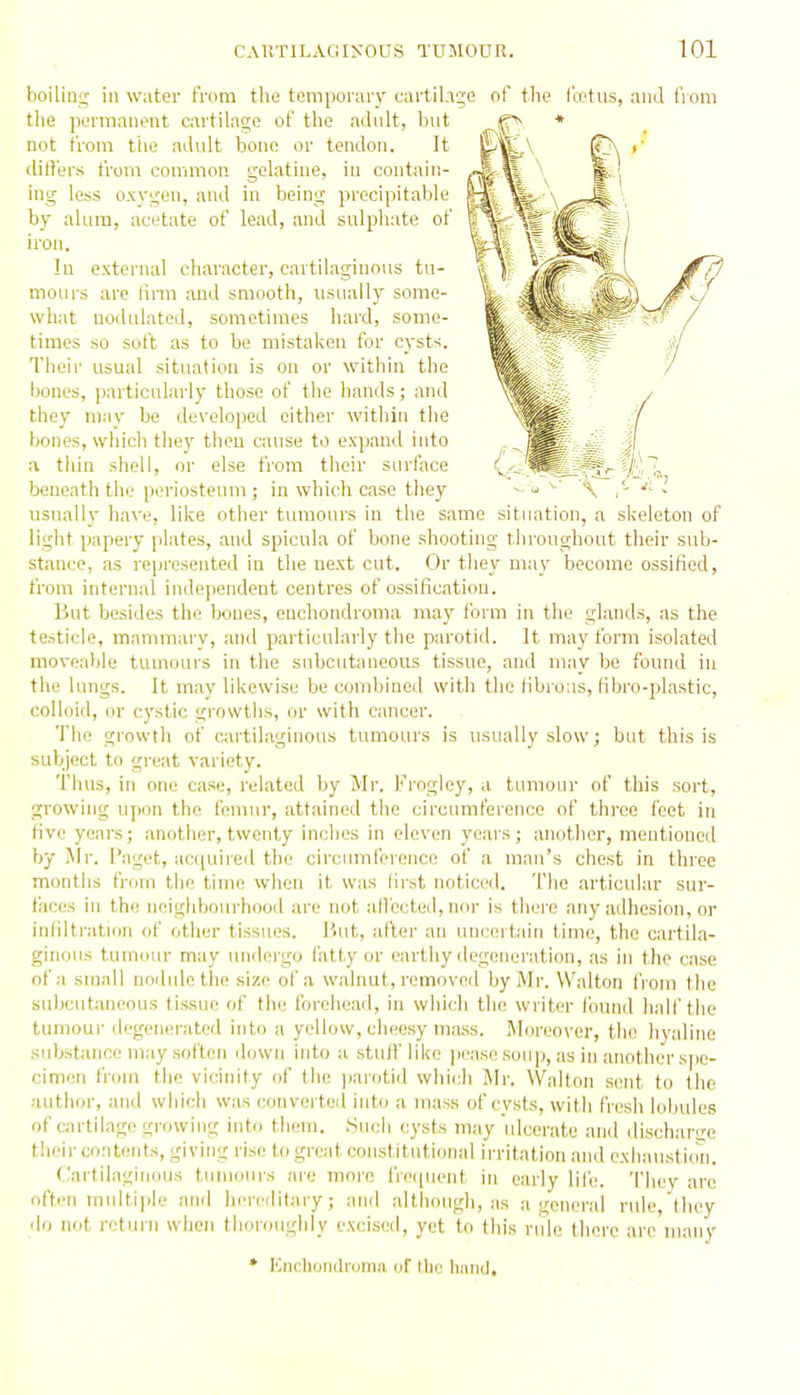 boilin;; in water from the temporary cartilage of tlie I'cetus, and fi om tlie permanent cartilage of the adult, but not from the adult bone or tendon. It ditlers t'rom common gelatine, in contain- ing less oxygen, and in being precipitable by alum, acetate of lead, and sulphate of iron. In external character, cartilaginous tu- mours are limi and smooth, usually some- what nodulated, sometimes hard, some- times so soit as to be mistaken for cysts. Their usual situation is on or within the bones, particularly those of the hands; and they may be developed either within the bones, which they then cause to expand into a thin shell, or else from their surface beneath the periosteum ; in which case they usually have, like other tumours in the same situation, a skeleton of light papery plates, and spicula of bone shooting throughout their sub- stance, as represented in the next cut. Or they may become ossified, from internal independent centres of ossification. But besides the Ixiues, enchondroma may form in the glands, as the te.->ticle, mammary, and particularly the parotid. It may form isolated movealile tumours in the subcutaneous tissue, and may be found in the lungs. It may likewise be combined with the fibrous, fibro-plastic, colloid, or cystic growths, or with cancer. The growth of cartilaginous tumours is usually slow; but this is subject to great variety. Thus, in one case, related by Mr. Frogley, a tumour of this sort, growing upon the femur, attained the circumference of three feet in five years; another, twenty inches in eleven years; another, mentioned by Mr. i'aget, acquired the circrmifereuce of a man's chest in three months from the time when it was (irst noticed. The articidar sur- faces in the neighbourhood are not atl'ccted, nor is there any adhesion, or infiltration of other tissues. But, after an uncertain time, the cartila- ginous tumour may undergo fatty or earthy degeneration, as in the case of a small nodidethe size of a walnut, removed by Mr. Walton from the subcutaneous tissue of the foi'chead, in which the writer tbund hall'the tumour degenerated into a yellow, cheesy mass. Moreover, the hj'aline substance may .soften down into a stuff like jieasc soup, as in another spe- cimen from the vicinity of the ))arotid which Mr. Walton sent to the author, and which was converted into a mass of cvsts, with fresh lobules of cartilage growing into them. .Such cysts may ulcerate and dischart'e their contents, giving rise to great constitutional irritation and exhaustidn. (Cartilaginous tumours are moi'n lVe(|uent in early life. They are often multiple and hereditary; and although, as a general rule, Ihey do not rctuiii when tlioronghiy excised, yet to this rule there arc many * Encliondrunia of llie lianil.