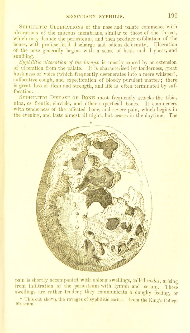 Syphilitic Ulcerations of the nose and palate commence with ulcerations of the mucous membrane, similar to those of the throat, which may denude the periosteum, and then produce exfoliation of the bones, with profuse fetid discharge and odious deformity. Ulceration of the nose generally begins with a sense of heat, and dryness, and snuliling. Syphilitic ulceration of the larnyx is mostly caused by an extension of ulceration from the palate. It is characterised by tenderness, great husliiness of voice (which frequently degenerates into a mere whisper), sufl'ocative cough, and expectoration of bloody purulent matter; there is great loss of flesh and strength, and life is often terminated by suf- focation. SvpuiLiTrc Disease of Bone most frequently attacks the tiljia, ulna, OS frontis, clavicle, and other superficial bones. It commences with tenderness of the affected bone, and severe pain, whicli begins in the evening, and lasts almost all night, but ceases in the daytime. The * pain is shortly accompanioil witli oblong swellings, called nodes, arisinc^ from infiltration of the periosteum witii lymph and soriuu. These swellings are rather tender; they communicate a doughy fcelino-, or • This cut, sliowa the ravages of syiiliilitic caries. From tlie liinu's Colleicp Museum.