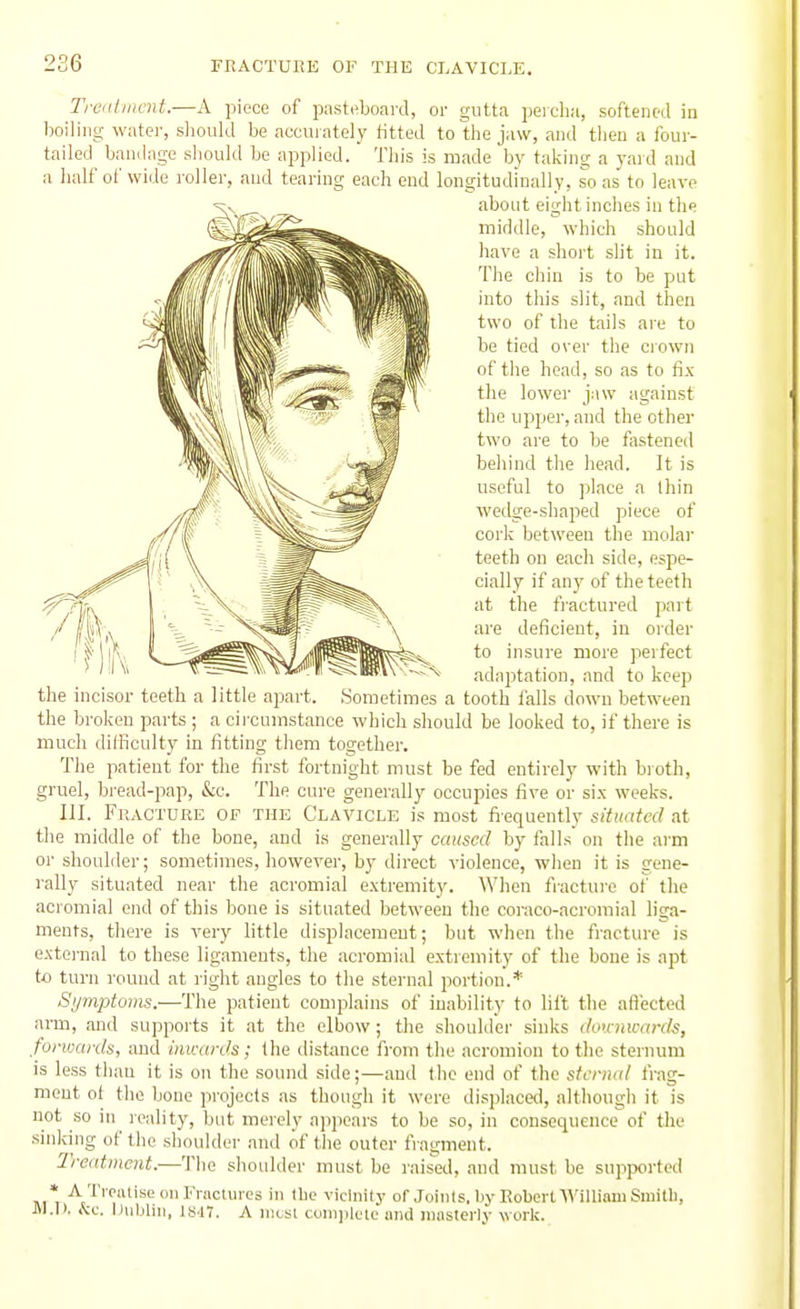 Treiiimcnt.—A piece of pasteboard, or gutta percha, softened in boiling water, should be accurately fitted to the jaw, and then a four- tailed bandage should be applied. This is made by taking a yard and a half of wide roller, and tearing each end longitudinally, so as to leave about eight inches in the middle, which should have a short sht in it. The chin is to be put into this slit, and then two of the tails are to be tied over the crown of the head, so as to fix the lower jaw against the upper, and the other two are to be fastened behind the head. It is useful to place a Ihin wedge-shaped piece of cork between the molai' teeth on each side, espe- cially if an}' of the teeth at the fractured part are deficient, in order to insure more perfect adaptation, and to keep the incisor teeth a little apart. Sometimes a tooth falls down between the broken parts ; a circumstance which should be looked to, if there is much difficulty in fitting them together. The patient for the first fortnight must be fed entirely with bioth, gruel, bread-pap, &c. The cure generally occupies five or six weeks. III. Fracture of the Clavicle is most fi-equently situated at the middle of the bone, and is generally caused by falls on the arm or shoulder; sometimes, however, by direct violence, when it is gene- rally situated near the acromial extremity. When fiacture of the acromial end of this bone is situated between the coraco-acromial liga- ments, there is very little displacement; but when the fracture is external to these ligaments, the acromial extremity of the bone is apt to turn round at i-ight angles to the sternal portion.* Si/mptoiiis.—The patient complains of inability to lift the afiectcd arm, and supports it at the elbow ; the shoulder sinks (hniwa>\k, forimnls, and iiucitn's; the dist;mce from the acromion to the sternum is less thau it is on the sound side;—.and the end of the sterna/ frag- ment ol the bone projects as thongh it were displacwl, althougli it is not so in reality, but merely appears to be so, in consequence of the sinking of the shoidder and of the outer fragment. Treatment.—The shoulder must be raised, and must be supported m*i '^,'^'''<'''S'=I'>cture3 in Ibc vicinity of Joints, Iiy Robert William Smith, JVM>. &c. Dublin, ls.17. A most coniplele und masterly work.