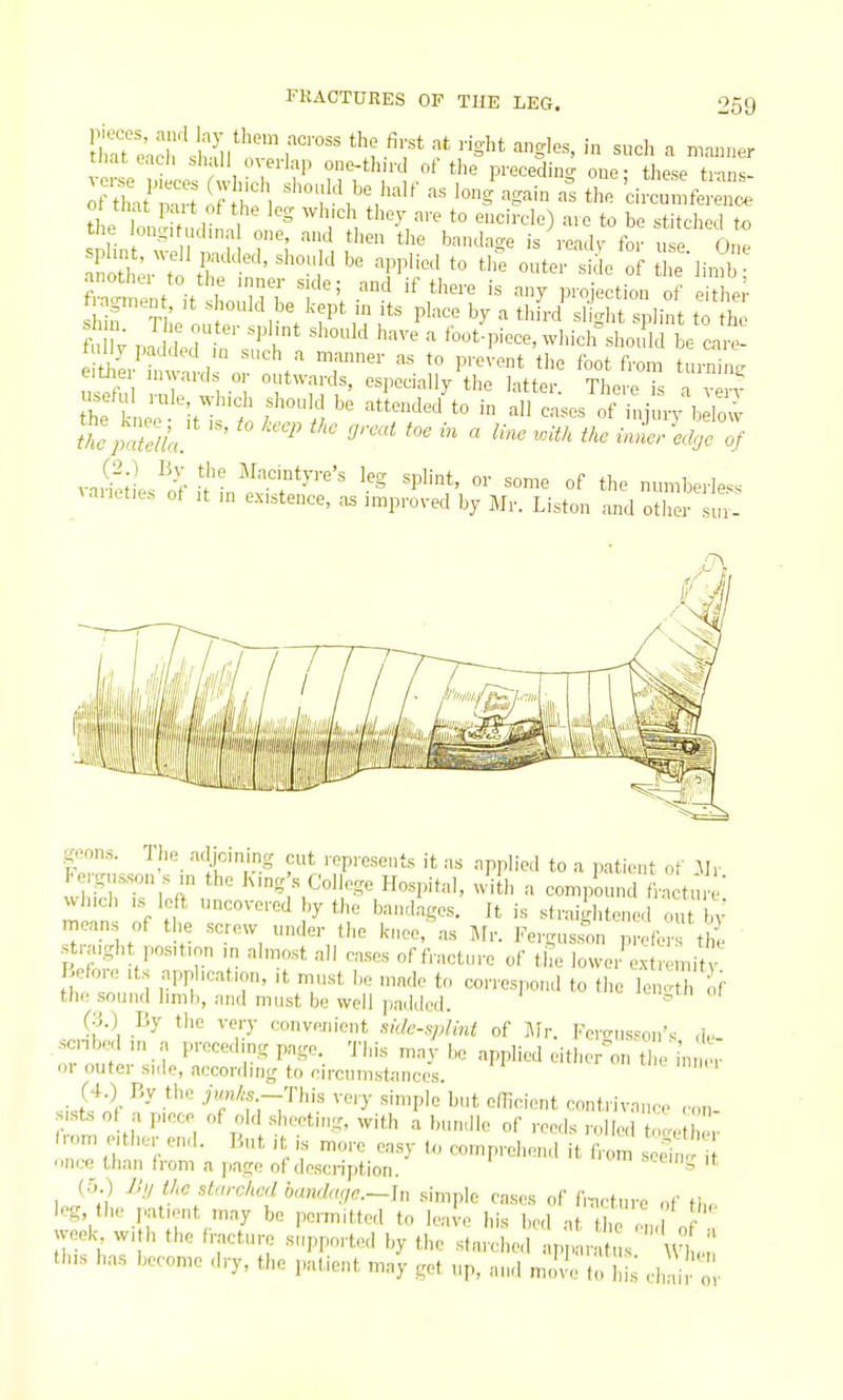 ir^t'e^ch'sSil?' '-'gl-. ^oh a manner tnateaci, shall overlap one-third of the preceding one- these trnns ot that pait of the leg wh.ch they are to encircle) are to be stitched to the long, udinal one, and then the bandage is readv for use One ai:ott;7 tr'''' '^P'^''^' *° outer si 1 e li„?b^ anothe. to the inner side; and if there is any projection of eithe.' full; ,n T T '^'^u' ^ '°«t-pioce,whicirshould be ca e- .° o 'twards, especally the latter. There is a very vaSiLs^Jt- J? ^^'■^.^''^'-'^'^ '.'^g ^^Pli»t. o>- some of the numberless ^ anet.es ot it in existence, as improved by Mr. Listen and other sui- geons. The adjcining cut represents it as applied to a patient of Mr Fergusson s in the King'.s College Hospital, With a compound lactt ' which IS left uncovered by the bandages. It is straightened u bV means of the screw under the knee, as Mr. Fergusson prefer thi straight position m almost all cases of fracture of the lower extmity Before Its application, it must be made to correspond to the Icn' h of the sound limb, and must be well ])addod. ' (3.) By the very convejiient sidc-splml of i\Ir. Fortruswn\ d,. scnbed in a preceding page. This may be applied eithor-'on ti Vim or outer side, according to circumstances ■Jfi •/'f^'f--Thi.s yery simple but cdiciont contrivnuce con- sists of a piece of old sheeting, with a bundle of roods rolle.1 , from either end. But it is more easy fo comprehend it from sSn once than from a page of description. ' (5 ) JJ// the starched bandm/e.— in simple cases of f,-ncture of ti„ leg, the patient may be pennitted to lealc his bed at the o ,, ' week, with the fracture supported by the sfnrclied apj,arat, s wLn this has become dry, the patient may get up, aiul mml t 1 s clini o