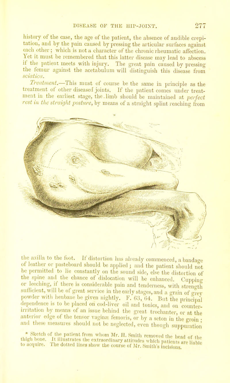 history of tlie case, the age of the patient, the absence of audible crepi- tation, and by the pain caused by pressing the articular surfaces against each other; which is not a character of the chronic rheumatic affection. Yet it must be remembered that this latter disease may lead to abscess if tlie patient meets with injmy. The great pain caused by pressing the femur against the acetabulum will distinguish this disease from gciaticit. Treatment.—This must of course be the same in principle as the treatment of other diseased joints. If the patient comes under treat- ment in the earliest stage, the .limb should be maintained at perfect rest in the strairjht posture, by means of a straight splint reaching from tlie axilla to the foot. If distortion lias already commenced, a bandage of leather or pa.steboard should be applied ; and the patient should not be permitted to lie constantly on the sound side, else the distortion of the spine and the chance of dislocation will be enhanced. Cuppinsr or leeching, if there is considerable pain and tenderness, with strength sulHcient, will be of great service in the early stages, and a grain of o-rey powder with henbane be given nightly. F. 63, (',4. But the princiDal dependence is to be placed on cod-liver oil and tonics, and on counter- irritation by means of an issue behind tiie great trochanter, or at the anterior edge of the tensor vagin;c femoris, or by a seton in the eroin • and these measures should not bo neglected, even though suppination • Sketch of t,li(. pnlient frnni wli„m Mr. 11. .Smitli removed tlie licad of tlie Ingh bone. illnslrntes Uie e.xtrnonlinary atlitiules wlilcl, Jinti^n e to ac(|iiirc. I lie dotted Imes sliow tUe course ol Mr. Sniilirs incisions.