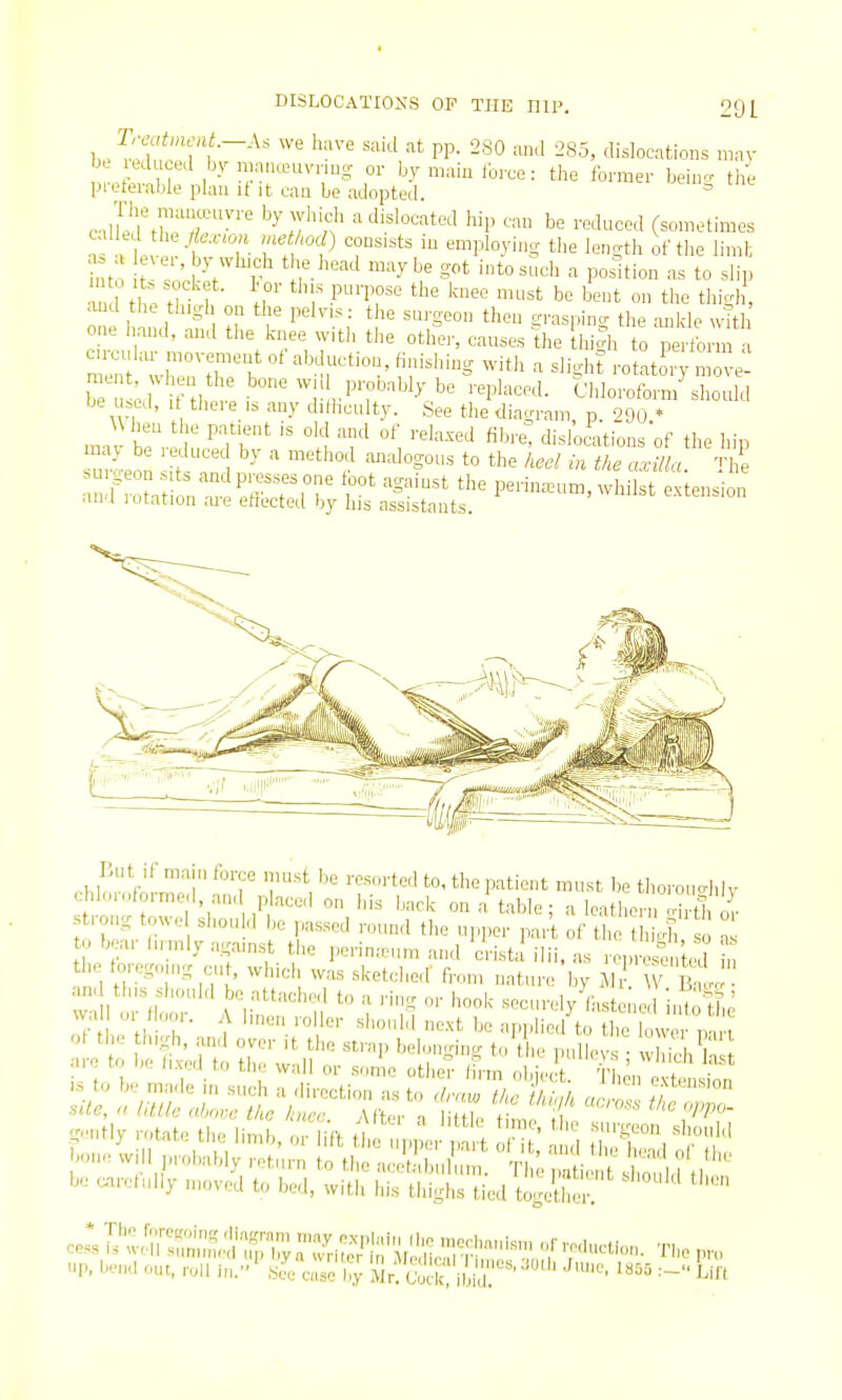 ), . PP- -85, dislocations mny be educed by raancGuvnno- or by main ibrce: tiie former beinc tlie preferable plan int can be adopted. uii^ uie cXuZT'''-'' ^T'^n' '-''•'^'^'■^t'^^l hip cau be reduced (sometimes ns . tv^ -f T- '^niploying tl,e len.tli of the limt • ; ^'-'^y 'l^ch the head maybe got into such a position as to slip u I tt t i 1 ''^ '^^^^ be bent on the thigh, and the thigh on the peh-is: tlie surgeon then srasnincr the ankle «^th one hand, and the knee with the otlfer, causes Ihe iri^h to p L-m ^ c.rcular movement of abduction, finishing with a slio-ht rotatory move f-tl. ^l:' Pr^^ly be l-eplaced. Cldo£n7sZdd be u.od, If there is any dithculty. See tlie diagram, p. 290 * \ hen the patient is old and of relaxed fibre, disloaitions of the hip f tat ^effri°r r ' Perina^i™, whilst extension ana lotation aie effected by his assistants. Lilt If main force must be resorted to, the patient must be thoroucrhiv <:hloioformed, and p aced on his back on a table; a leather S o^ strong towe shou d be passed round the upper part of th t i'd, o a to bear lirmly agamst the perin.cm and crista' ilii. as ropr sci W in the foregoni. cut, which was sketched' from nature by M V Bn J ' p...tly ,.tate the limb, o^Hft ^l^^ J ^ Z'Z, tJ' -lie will probably return to the acetabulum. T ; i, W be aarcluily moved to bed, with ids thighs tied together. ce:,l^:«-^;-^-- pin up, lju.| out, roll in,^ .See case l.y iMr. C'uck, ibid.