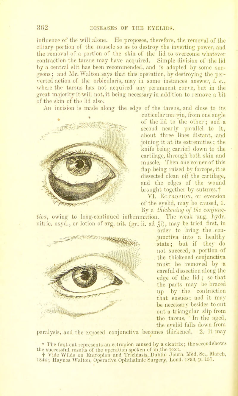 influence of the will alone. He proposes, tberefoiv, tlio removal of the ciliary portion of the muscle so as to destroy the inverting power, and the i-emoval of a portion of the skin of the lid to overcome whatever contraction the tarsus may have acquired. Simple division of the lid by a central slit has been recommended, and is adopted by some sur- geons; and ]\Ir. Walton says that this operation, by destroying the per- verted action of the orbicularis, may in some instances answer, i. c, where the tarsus has not acquired any pei'manent curve, but in the great majority it will not, it being necessar3Mn addition to I'emove a bit of the skin of the lid also. An incision is made along the edge of the tarsus, and close to its cuticular margin, from one angle of the lid to the other; and a second nearly parallel to it, about three lines distant, and joining it at its extremities ; the knife being carried down to the cartilage, through both skin and muscle. Then one corner of this flap being raised by foi'ceps, it is dissected clean oO the cartilage, and the edges of the wound brought together by sutures.f VI. EcTROPiox, or eversion of the eyelid, may be caused, 1. By a tliiclicaiiiij of tlic conjunc- tiva, owing to long-continued inflammation. The weak ung. liydr. nitric, oxyd., or lotion of arg. nit. (gr. ii. ad ^i), may be tried first, in order to bring the con- junctiva into a healthy state; but if they do not succeed, a portion of the thickened conjunctiva must be removed by a careful dissection along the edge of the lid ; so that the parts may be braced up by the contraction that ensues: and it may be necessary besides to cut out a triangular slip from the tarsus. In the aged, the eyelid i'alls down from paralysis, and tlie ex))Osed conjunctiva becomes thickened. 2. It may * The first cut represents nn eclropion ciuisod by a cicatrix; the second sliows tlie successful resulls ot llie ojievatiuii spoken ol' in tlic text. t Vide Willie on lOnlropion and Tricliiasis, iniblin Jourri. Jlcd. Sc., JIarcli, iai4 ; Hiiynes Wiiltou, Operalive Opbtluilunc LSurgcry, Loud. 185:i, p. 157.