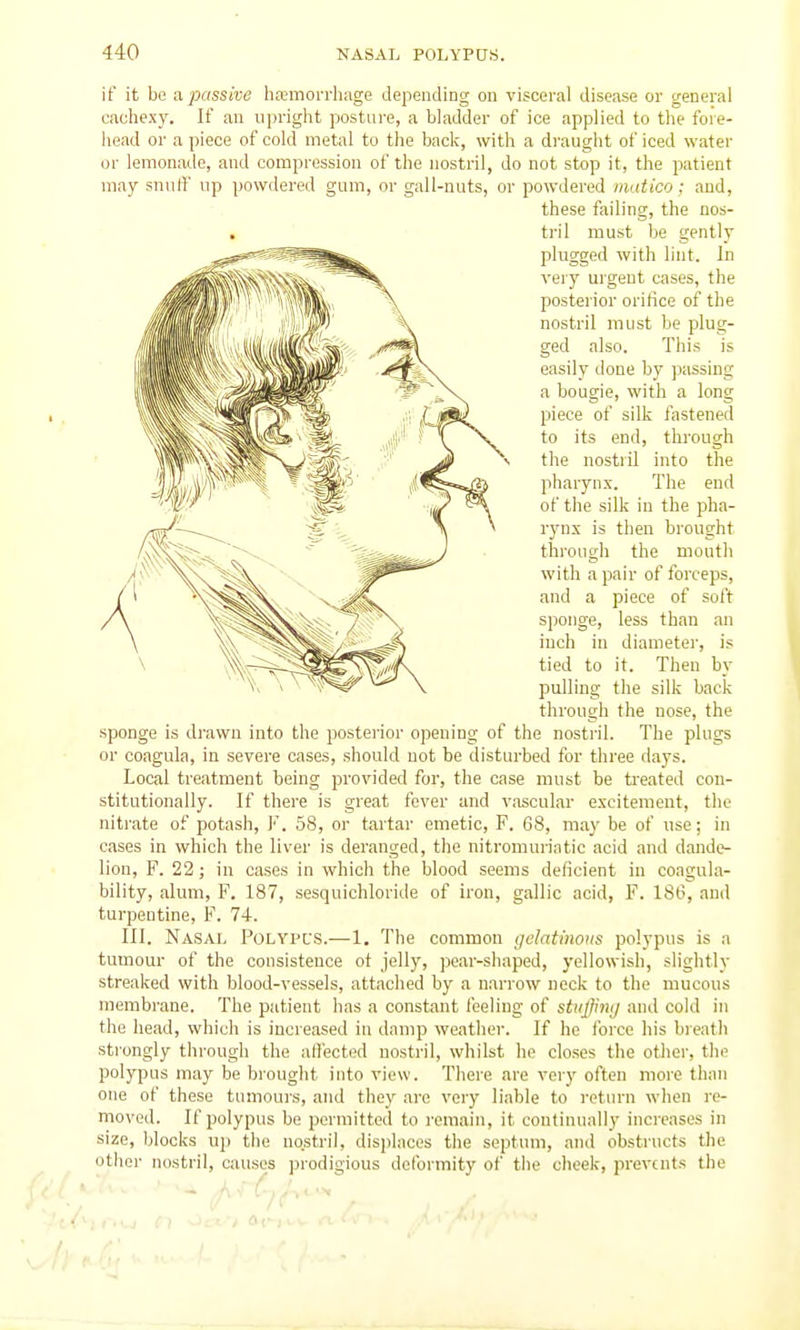 if it be a.passive hfemorrhage depending on visceral disease or general cachexy. If an upright posture, a bladder of ice applied to the fore- head or a piece of cold metal to the back, with a draught of iced water or lemonade, and compression of the nostril, do not stop it, the patient may snulf up powdered gum, or gall-nuts, or powdered inatico; and, these failing, the nos- tril must be gently plugged with lint. In veiy urgent cases, the posterior orifice of the nostril must be plug- ged also. This is easily done by jjassing a bougie, with a long piece of silk fastened to its end, through V the nostril into the pharynx. The end of the silk in the pha- rynx is then brought through the mouth with a pair of forceps, and a piece of soft sponge, less than an inch in diameter, is tied to it. Then by pulling the silk back through the nose, the sponge is drawn into the posteiior opening of the nostril. The pings or coagula, in severe cases, should not be disturbed for three days. Local treatment being provided for, the case must be ti'eated con- stitutionally. If there is great fever and vascular excitement, the nitrate of potash, J'. 58, or tartar emetic, F. 68, may be of use; in cases in which the liver is deranged, the nitromuriatic acid and dande- lion, F. 22; in cases in which the blood seems deficient in coagula- bility, alum, F. 187, sesquichloride of iron, gallic acid, F. 186, and turpentine, F. 74. III. Nasal Polypcs.—1. The common (jelatinous polypus is a tumour of the consistence ot jelly, pear-shaped, yellowish, slightly streaked with blood-vessels, attached by a narrow neck to the mucous membrane. The patient has a constant feeling of stiiffinij and cold in the head, which is increased in damp weather. If he force his bieath strongly through the aH'ected nostril, whilst he closes the other, the polypus may be brouglit into view. There are vcrj' often more than one of these tumours, and they are very liable to i-eturn when re- moved. If polypus be permitted to remain, it continually increases in size, blocks uj) the nostril, displaces the septum, and obstructs the otlier nostril, causes jirodigious deformity of the cheek, prevents the