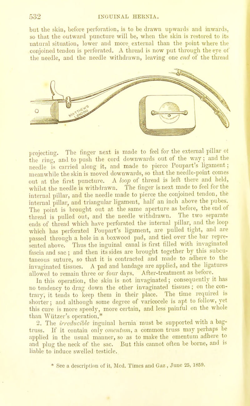 but the skin, before perforation, is to be drawn upwards and inwards, so tliat the outwai-d puncture will be, when the skin is restored to its natural situation, lower and more external than the point where the conjoined tendon is perforated. A thread is now put through the eye of the needle, and the needle withdrawn, leaving one end of the thread ]jrojecting. The finger next is made to feel for the external pillar ot the ring and to push the cord downwards out of the way; and the needle Is carried along it, and made to pierce Poupart's ligament : meanwhile the skin is moved downwards, so that the needle-point comes out at the first puncture. A loop of thread is left there and held, whilst the needle is withdrawn. The finger is next made to feel for the internal pillar, and the needle made to pierce the conjoined tendon, the internal pillai-, and triangular ligament, half an inch above the pubes. The point is brought out at the same aperture as before, the end of thread is pulled out, and the needle withdrawn. The two separate ends of thread which have perforated the internal pillar, and the loop which has perforated Poupart's ligament, are pulled tight, and are passed through a hole in a boxwood pad, mid tied over the bar repre- sented above. Thus the inguinal canal is first filled with inyaginated fascia and sac ; and then its sides are brought together by this subcu- taneous suture, so that it is contracted and made to adhere to the in\-aginated tissues. A pad and bandage are applied, and the ligatures allowed to remain three or four days. After-treatment as before. In this operation, the skin is not invaginated; consequently it has no tendency to drag down the other invaginated tissues ; on the con- trary, it tends to keep them in their jilace. The time required is shorter; and although some degree of varicocele is apt to follow, yet this cure is more speedy, more certain, and less painful on the whole than Wiitzer's operation.* 'i. The in-cdvc'Me inguinal hernia must be supported with a bag- truss. If it contain oniy omentum, a common truss may perhaps be applied in the usual mannei', so as to make the omentum adhere to and plug the neck of the sac. But this cannot often be borne, and is liable to induce swelled testicle. * See a description uf it, Med. Times and Gaz , June 25, 1859.