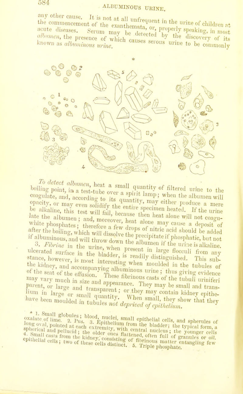 ALDCMINOUS UKINK. -«te diseases. Sen™ mny t ToJectei T';^ T''^' the presence of ^vhich ca ses 1 ' d^soov^.y of iu fniowD as albwumoiis wine. ''^ '^e commonly boi£/S:;t,t:';:^.;Sj:.r q-ntityof fi,te,-ed „nne to the coagula/e, and, accSn: to H ' irtV'^' '^ f '^ oP'icity, or may even soJidifv (he Pnt ^' ^ » mere be alkaline, th s tes v 1 1 ii I f™e tlK^IddnevTrnd UX '-'l^'^' i'> the tubn e of of the seat'of th eflbZn^ 1 ^''T ' S'-'-S evidence may va.-v much in siz ml nTf n '^ '^ iteri P'^-ent, or large anftrZl ' o'';. '^ '^'^ ■™ large'or sma o « / °i^^y'^-y;^°^^'^ Sidney ey^itho- have been moulded ii, tuZZ i y *l'ey show that they tLiDuJcb not depnvcd of epithelium. ''^''^^^'^T\Lt^^^^^^ s>«ll epitholial cells, and sphernle. of l°nK owU, pointed at c eil oufc™ . l,,'''™' ^ '^'''^l--''-' ^liety, ' S , flU-MNc,Ua,,dpelhidd tie o iV /i/^'^n'' '^'^'''^ i tl'^ ■Un>ncer cell ^PUlicna, ecus; two of tUc.e ^ells °'^^l^^^^^^^^ f-v