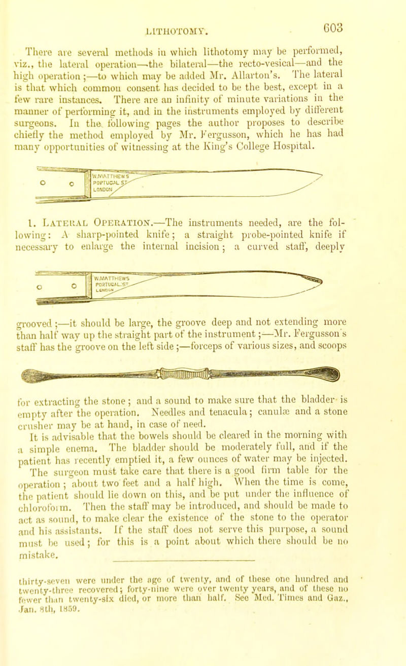 There are several methods iu which lithotomy may be performed, viz., the lateral operation—the bilateral—the recto-vesical—and the hii^h operation;—to which may be added Mr. AUarton's. The lateral is that which common consent has decided to be the best, except in a few rare instimces. There are au infinity of minnte variations in the manner of performing it, and in the instruments employed by dilTerent snrgeons. In the following pages the author proposes to describe chiefly the method employed by Mr. Kergusson, which he has had many opportunities of witnessing at the King's College Hospital. I. Lateral Operation'.—The instruments needed, are the fol- lowing: A sharp-pointed knife; a straight probe-pointed knife if necessary to enlarge the internal incision; a curved staff', deeply gi-ooved ;—it should be large, the groove deep and not extending more than half way up the straight part of the instrument;—Mr. Fergusson's staff has the groove on the left side ;—forceps of various sizes, and scoops for extracting the stone ; and a sound to make sure that the bladder- is empty after the operation. Needles and tenacula; canulaj and a stone crusher may be at hand, in case of need. It is advisable that the bowels should be cleared in the morning with a simple enema. The bladder should be moilerately full, and if the patient has recently emptied it, a few ounces of water may be injected. The surgeon must take care that there is a good firm table for the operation ; about two feet and a half high. When the time is come, the patient should lie down on this, and be put under the influence of clilorofoim. Then the staffmay be introduced, and should be made to act as sound, to make clear the existence of the stone to the operator and his assistants. If the staff does not serve this purpose, a sound must be used; for this is a point about which there should be no mistake. ihirty-seven were initler the iigo of twenty, and of these one Umnlrcd ami Iwenty-tlirce recovered; forty-nine were over twenty years, and of tliese no fewer tliun twenty-six died, or more than Imlf. See Med. Times and Gaz., Jan. Htli, IH59.