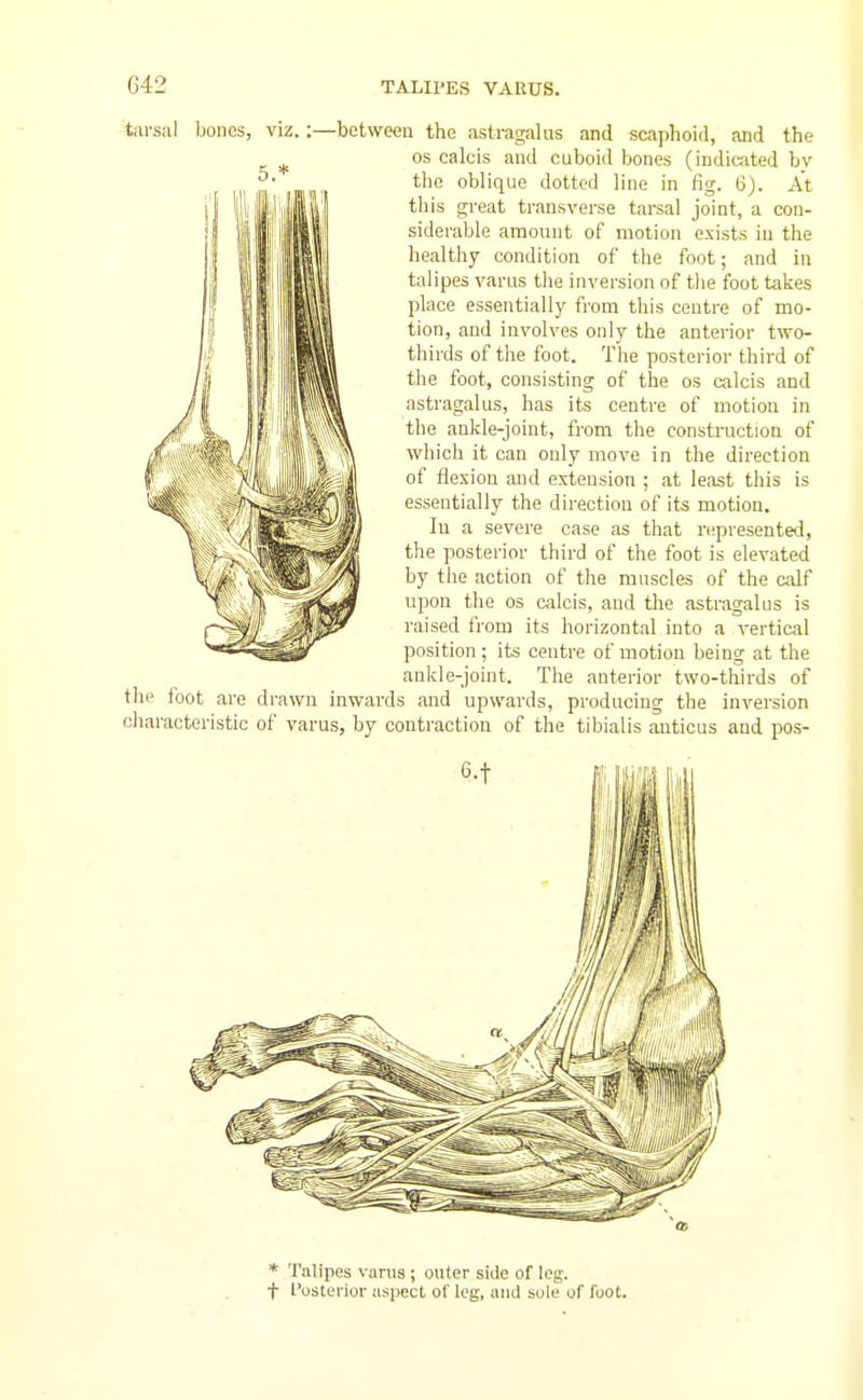 tarsal bones, viz.:—between the astragalus and scaphoid, and the OS calcis and cuboid bones (indicated bv the oblique dotted line in fig. 6). At this great transverse tarsal joint, a con- siderable amount of motion exists in the healthy condition of the foot; and in talipes varus the inversion of the foot takes place essentially from this centre of mo- tion, and involves only the anterior two- thirds of the foot. The posterior third of the foot, consisting of the os calcis and astragalus, has its centre of motion in the ankle-joint, from the construction of which it can only move in the direction of flexion and extension ; at least this is essentially the direction of its motion. In a severe case as that njpresented, the posterior third of the foot is elevated by tlie action of the muscles of the calf upon the os calcis, and the astragalus is raised from its horizontal into a vertical position ; its centre of motion being at the ankle-joint. The anterior two-thirds of the foot are drawn inwards and upwards, producing the inversion characteristic of varus, by contraction of the tibialis anticus and pos- * Talipes varus ; outer side of leg. t Posterior aspect of leg, and sole of foot.