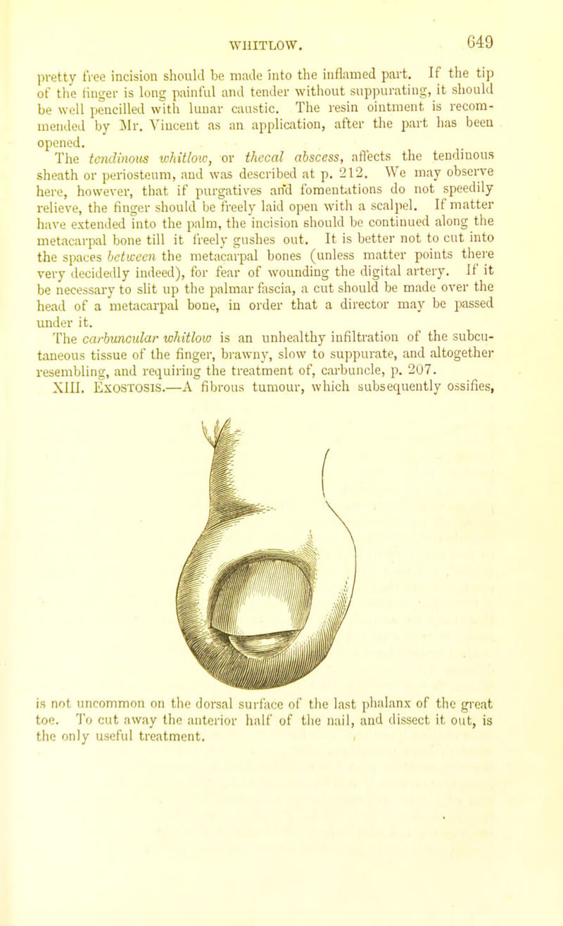 WHITLOW. pretty free incision should be made into tlie iuflnmed part. If the tip of the finger is long painful and tender without suppurating, it should be well pencilled with lunar caustic. The resin ointment is recom- mended by Ur. Vincent as an application, after the part has been opened. The tendinous whitlow, or thecal abscess, afl'ects the tendinous sheath or periosteum, and was described at p. 212. We may obsei-ve here, however, that if purgatives and fomentiitions do not speedily relieve, the finger should be freely laid open with a scalpel. If matter have extended into the palm, the incision should be continued along the metacarpal bone till it freely gushes out. It is better not to cut into the spaces between the metacarpal bones (unless matter points there very decidedly indeed), for fear of wounding the digital artery. If it be necessary to slit up the palmar fascia, a cut should be made over the head of a metacarpal bone, in order that a director may be passed under it. The carbuncular whitlow is an unhealthy infiltration of the subcu- taneous tissue of the finger, brawny, slow to suppurate, and altogethei- resembling, and requiring the treatment of, carbuncle, p. 207. XIII. Exostosis.—A fibrous tumour, which subsequently ossifies. is not uncommon on the dorsal surface of the last phalanx of the great toe. To cut away the anterior half of the nail, and dissect it out, is the only useful treatment.