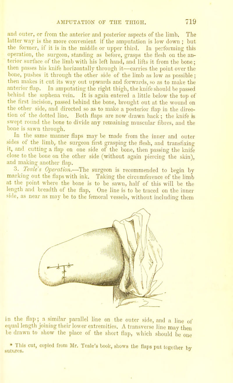 and outer, or from the anterior and posterior aspects of tlie limb. The latter way is the more convenient if the amputation is low down ; but the former, if it is in the middle or upper third. In performing this operation, the surgeon, standing as before, grasps the flesh on the an- terior surface of the limb with his left hand, and lifts it from the bone; then passes his knife horizontally through it—carries the point over the bone, pushes it through the other side of the limb as low ,as possible; then makes it cut its way out upwards and forwards, so as to make the anterior flap. In amputating the right thigh, the knife should be passed behind the saphena vein. It is again entered a little below the top of tlie first incision, passed behind the bone, brought out at the wound on the other side, and directed so as to make a posterior flap in the direc- tion of the dotted line. Both flaps are now drawn back; the knife is swe[it round the bone to divide any remaining muscular fibres, and the bone is sawn through. In the same manner flaps may be made fi-om the inner and outer sides of the limb, the surgeon first grasping the flesh, and transfixing it, and cutting a fiap on one side of the bone, then passing the knife close to the bone on the other side (without again piercing the skin), and making another flap. 3. Teak's Operation.—The surgeon is recommended to begin by marking out the flaps with ink. Taking the circumference of the limb at the point where the bone is to be sawn, half of this will be the length and breadth of the flap. One line is to be traced on the inner side, as near as may be to the femoral vessels, without including them in the fla]); a similar parallel line on the outer side, and a line of equal length joining their lower extremities. A transverse lino may then be drawn to show the place of the short flap, which should be oue * This cut, copied from Mr. Tcale's book, shows tlic flaps put tocellier sutiires.