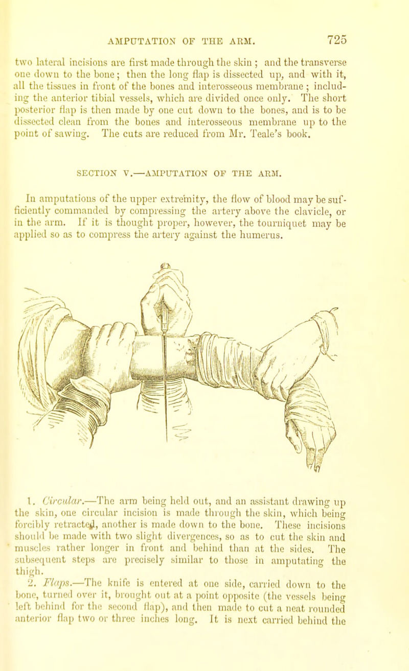 two lateral incisions are first made through the skiu ; and the transverse cue down to the bone; then the long flap is dissected up, and with it, all the tissues in front of the bones and interosseous membrane ; includ- ing the anterior tibial vessels, which are divided once only. Tlie short posterior flap is then made by one cut down to the bones, and is to be dissected clean from the bones and interosseous membrane up to the point of sawing. The cuts are reduced from Mr. Teale's book. SECTION V.—AMPUTATION OF THE ARM. In amputations of the upper extremity, the flow of blood may be suf- ficiently commanded by compressing the artery above the clavicle, or in the arm. If it is thought proper, however, the tourniquet may be applied so as to compress the artery against the humerus. 1. Circular.—The arm being held out, and an assistant drawing up the skin, one circular incision is made tlirough the skin, which being forcibly retracte^l, another is made down to the bone. Tliese incisions should be made with two slight divergences, so as to cut the skin and muscles rather longer in front and behind than at the sides. The subsequent steps are precisely similar to those in amputating the thigh. 2. Flaps.—The knife is entered at one side, carried down to the bone, turned over it, brought out at a point opposite (the vessels being left behind for the second flap), and then made to cut a neat rounded anterior flap two or three inches long. It is next carried behind the